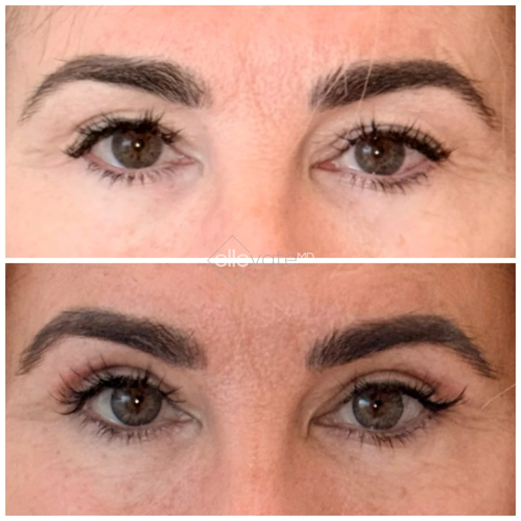 Before and after front-facing eyes showing improved eyelid position and reduced puffiness