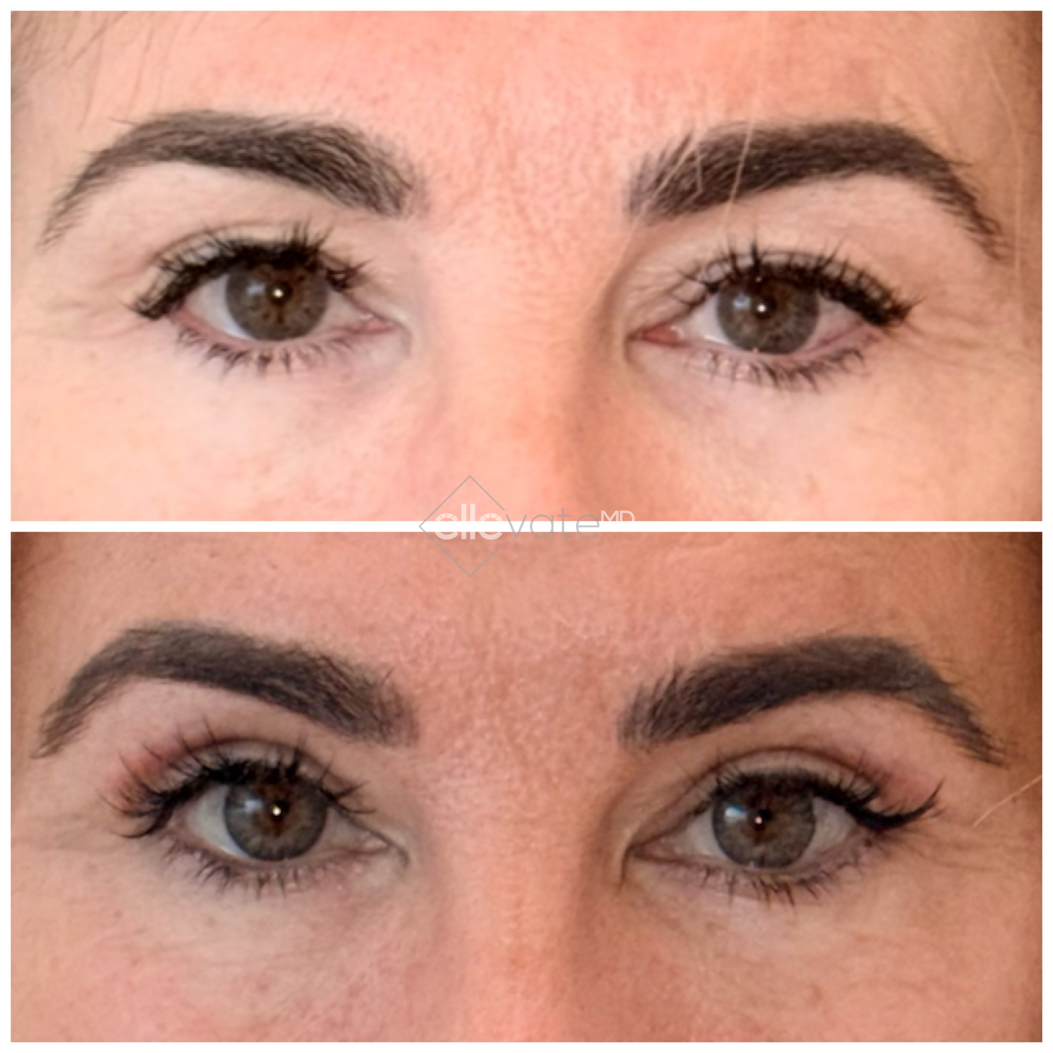 Before and after front-facing eyes showing improved eyelid position and reduced puffiness