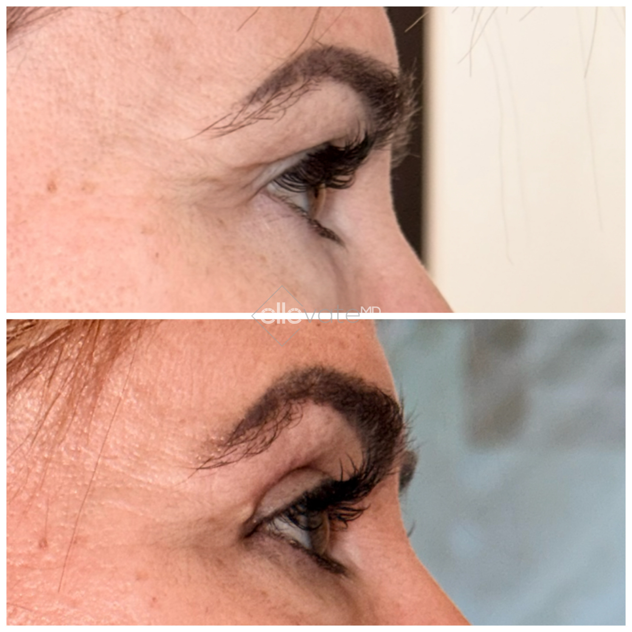 Side profile before and after of closed eye showing improved eyelid contour and lift