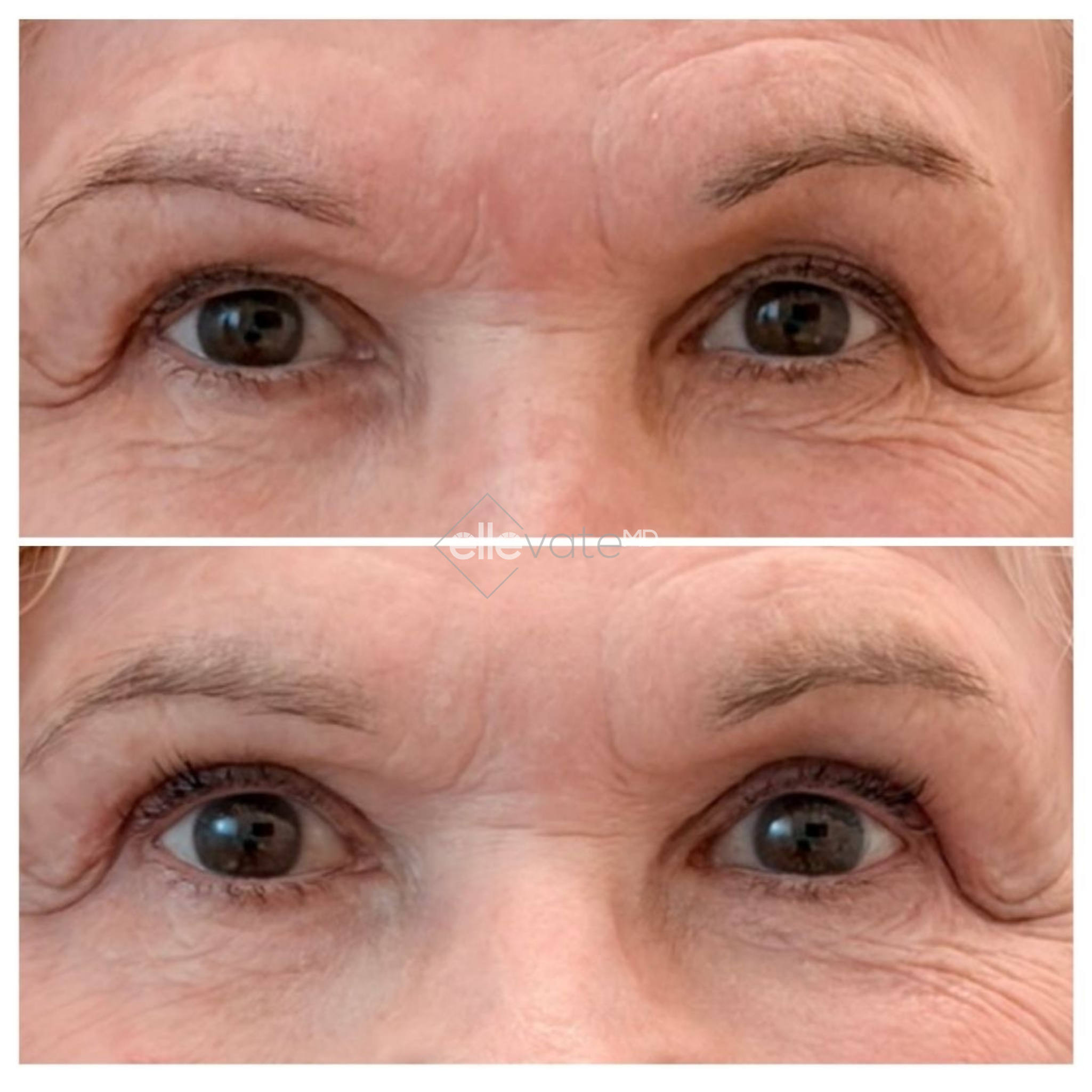 Before and after eye area comparison showing reduced crow's feet and improved skin texture