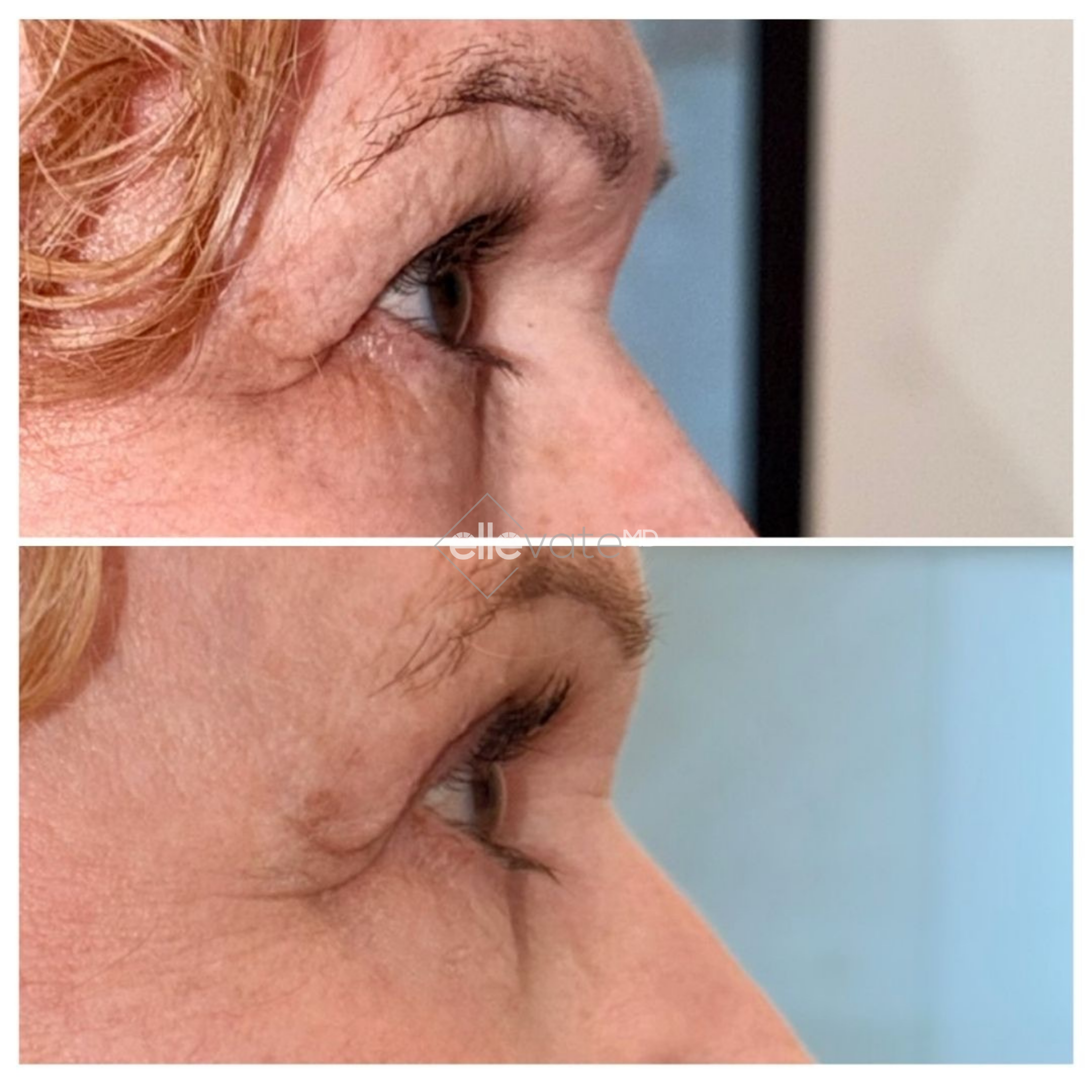 Side profile before and after showing improved eye area contour and reduced wrinkles