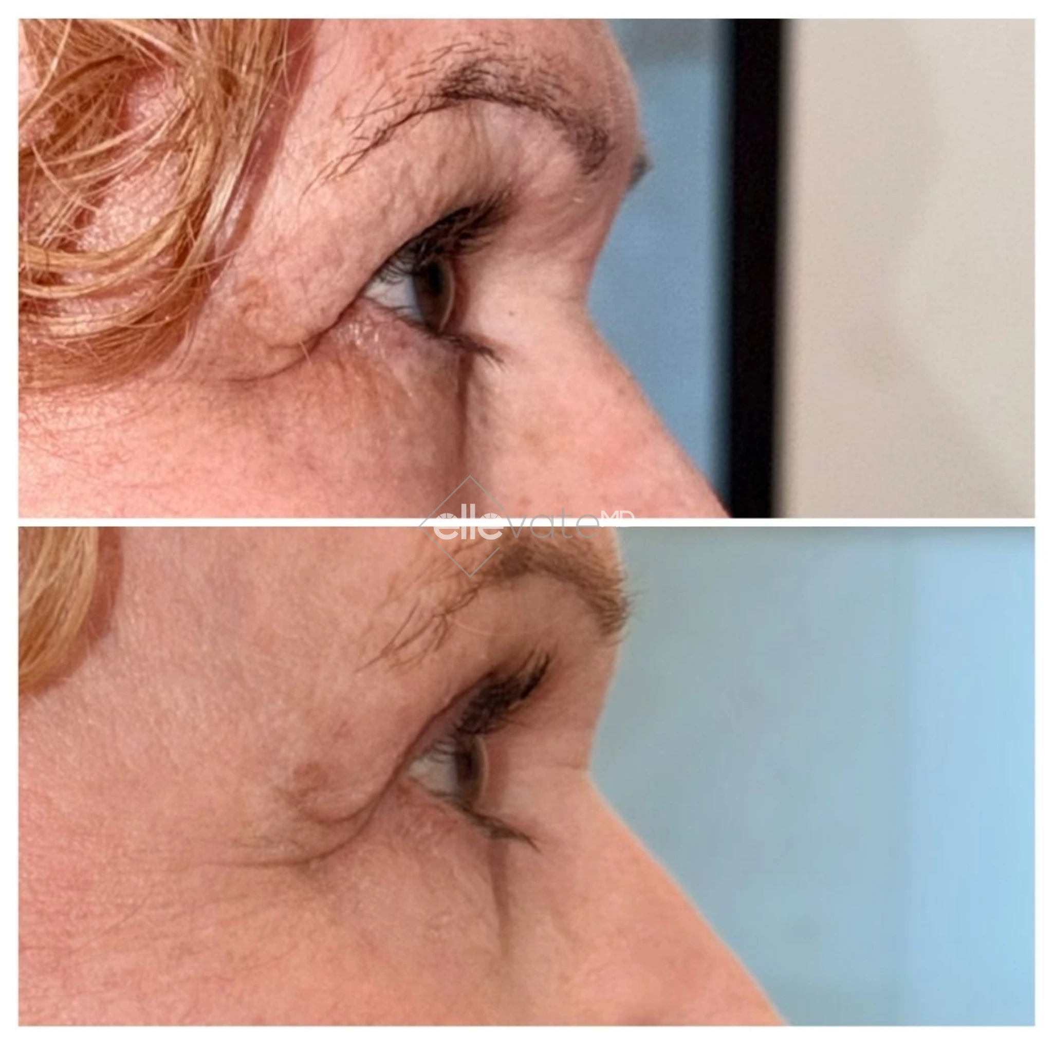 Side profile before and after showing improved eye area contour and reduced wrinkles
