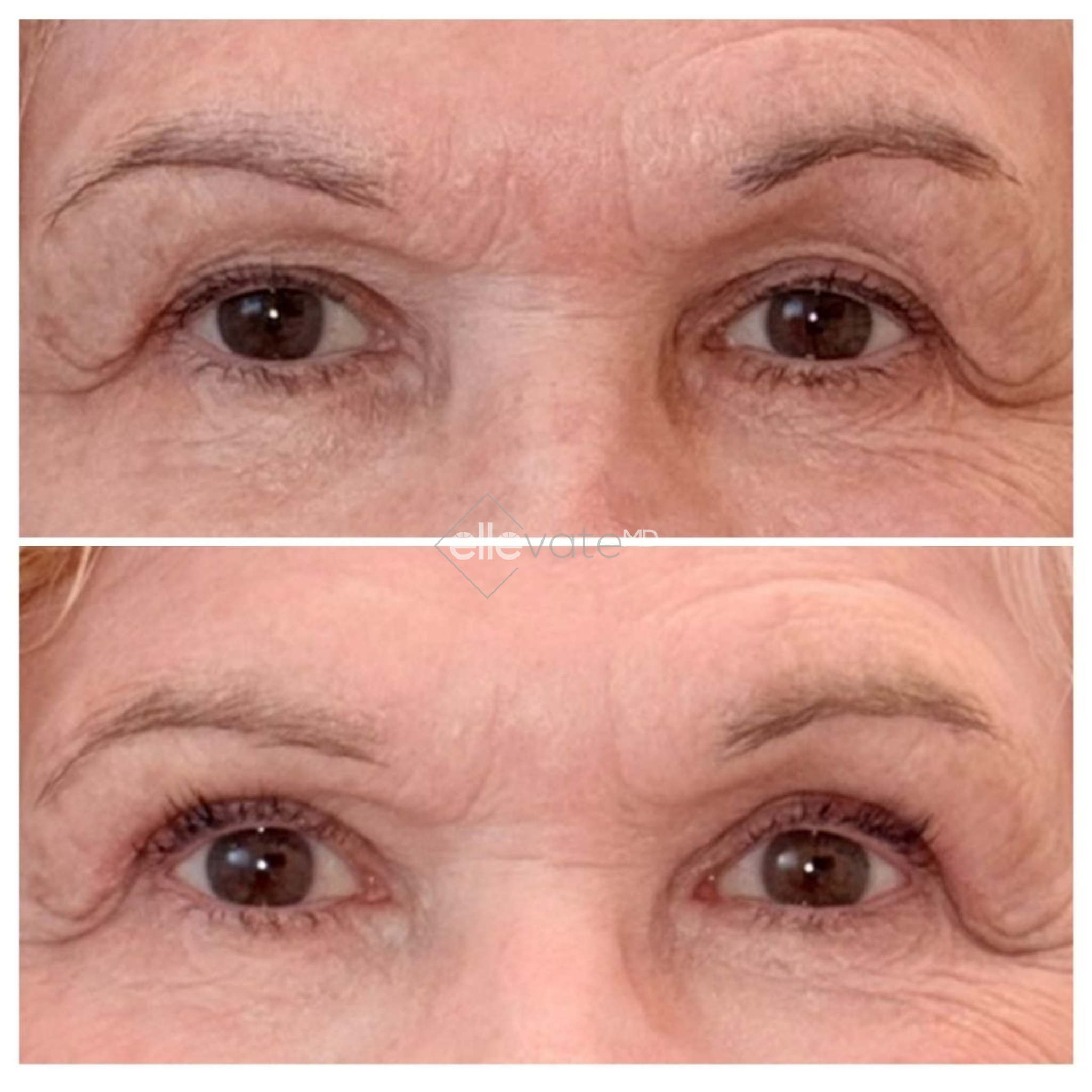 Before and after frontal eye view showing lifted appearance and smoothed fine lines