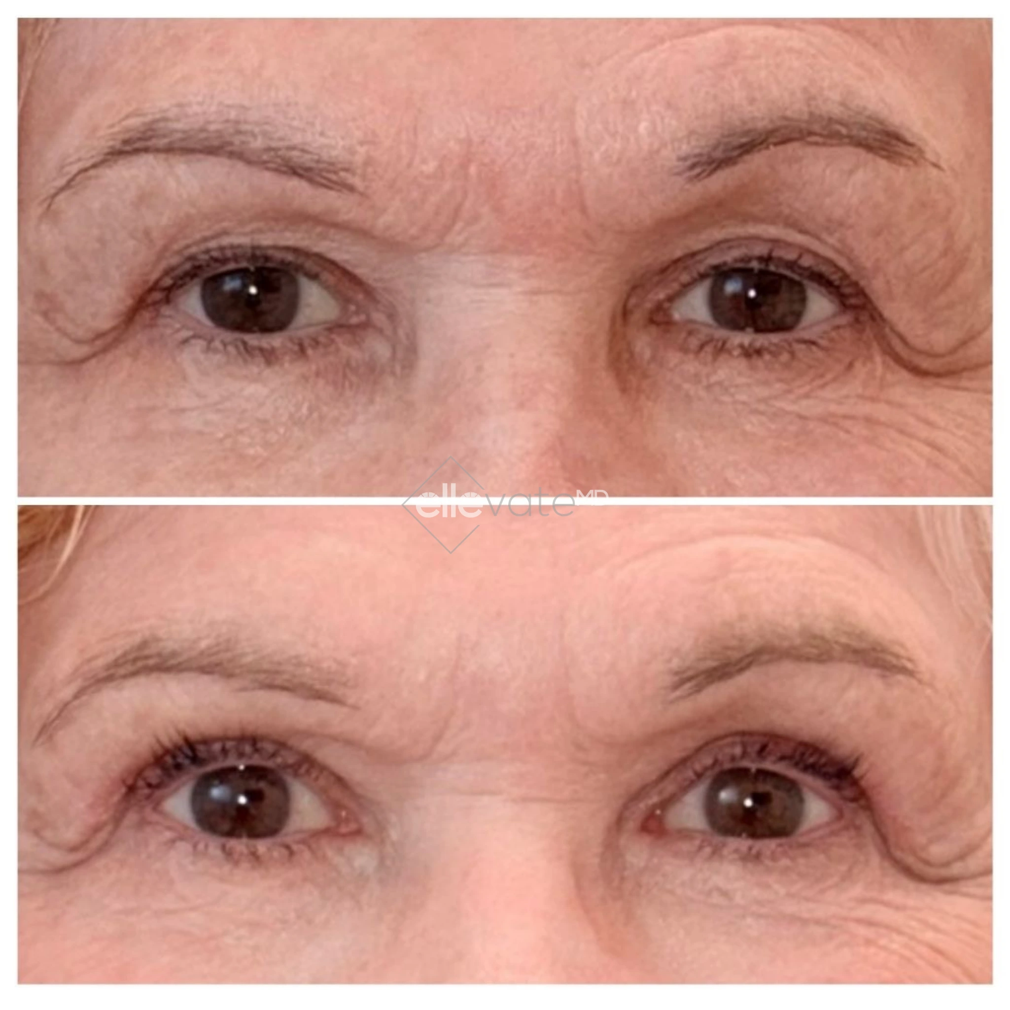 Before and after frontal eye view showing lifted appearance and smoothed fine lines
