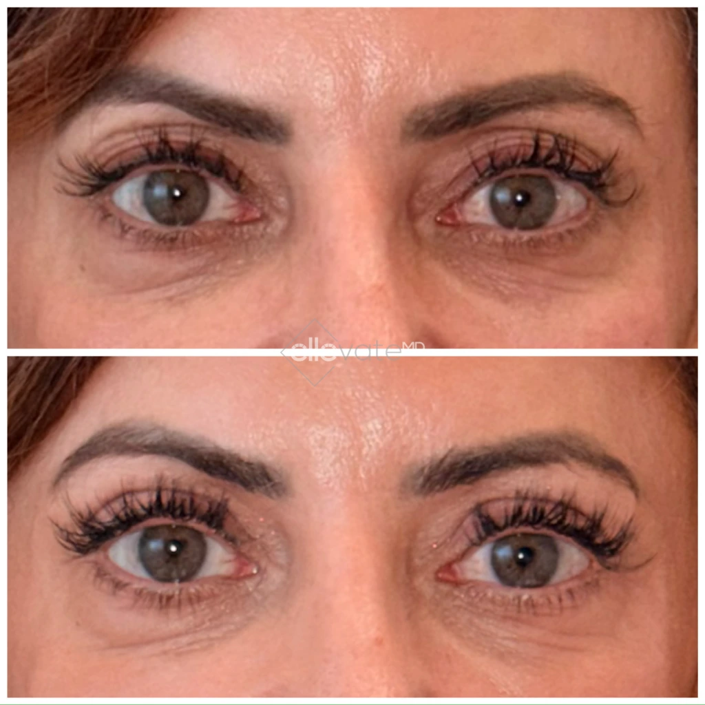Before and after frontal view showing lifted eyes with improved eyelid contour