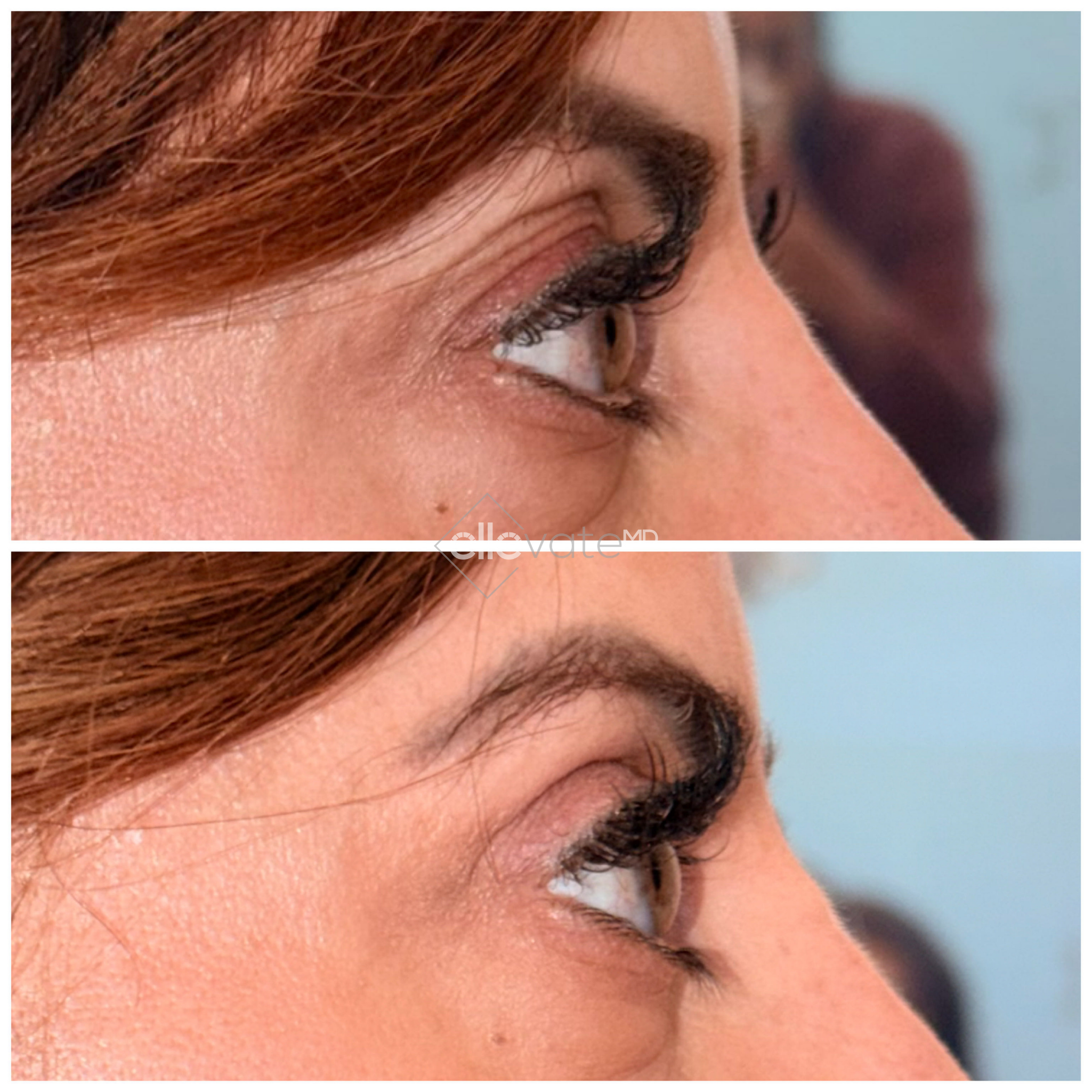 Side profile before and after demonstrating enhanced eye definition and lifted brow area