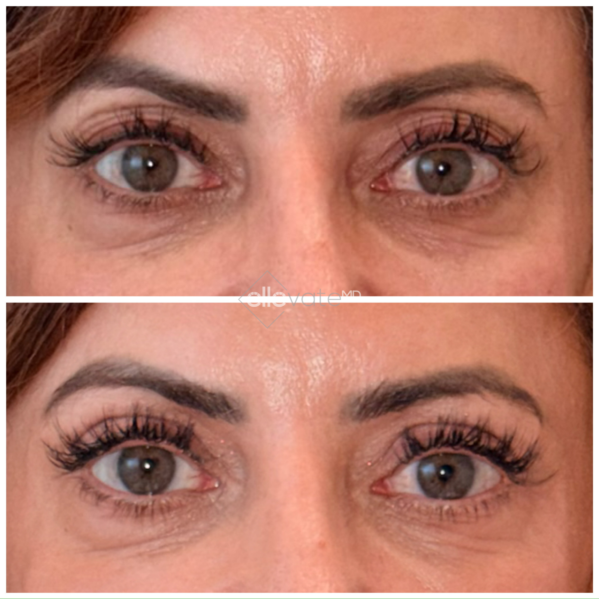 Before and after frontal view showing lifted eyes with improved eyelid contour