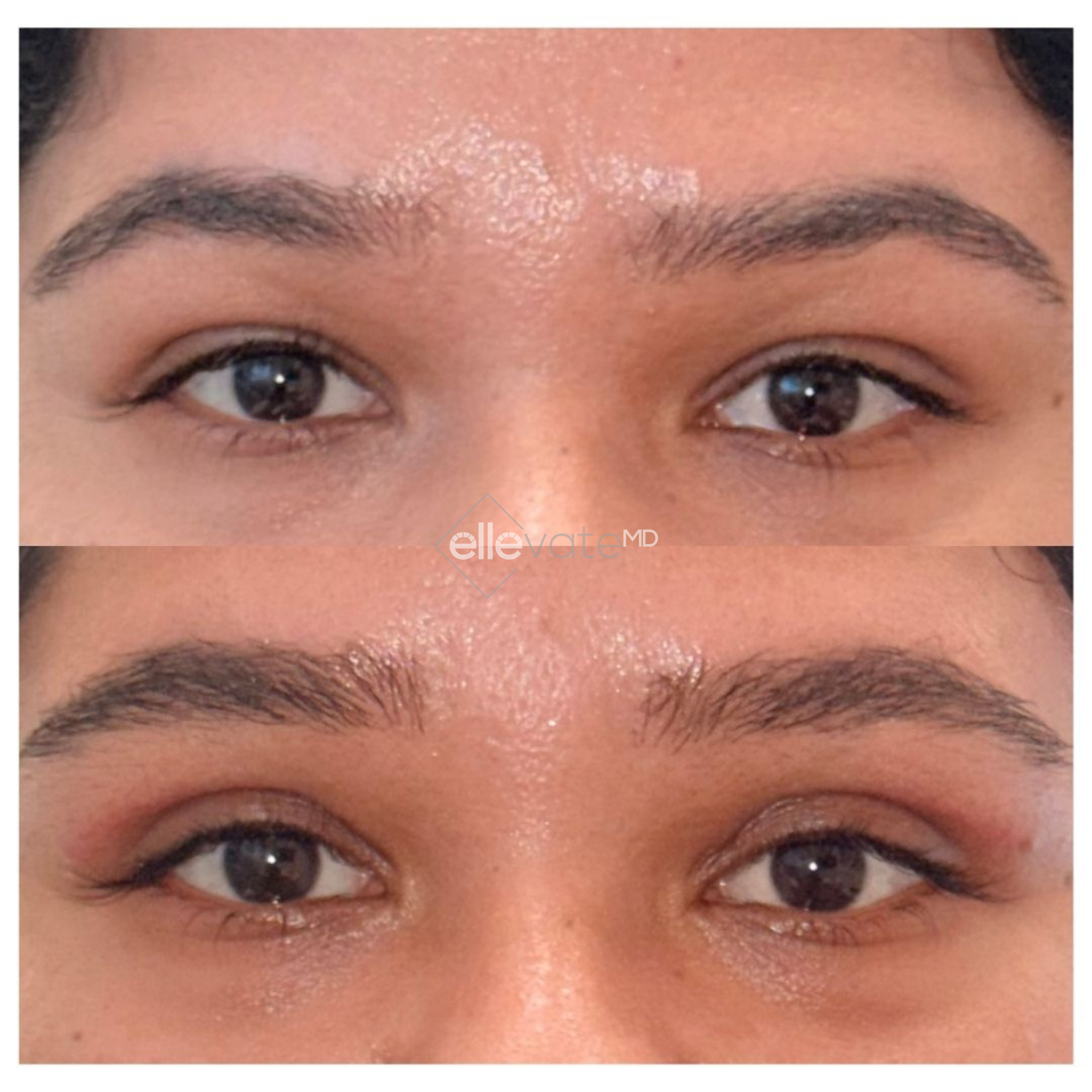 Before and after frontal eye comparison showing lifted brow and reduced under-eye sagging