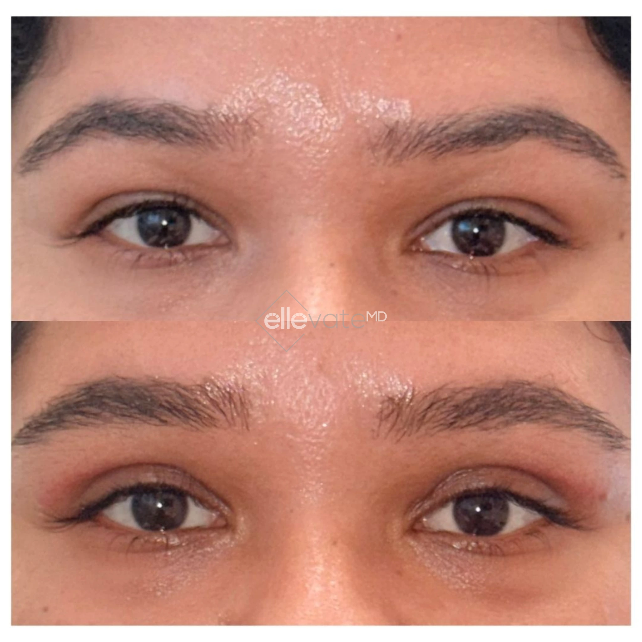 Before and after frontal eye comparison showing lifted brow and reduced under-eye sagging