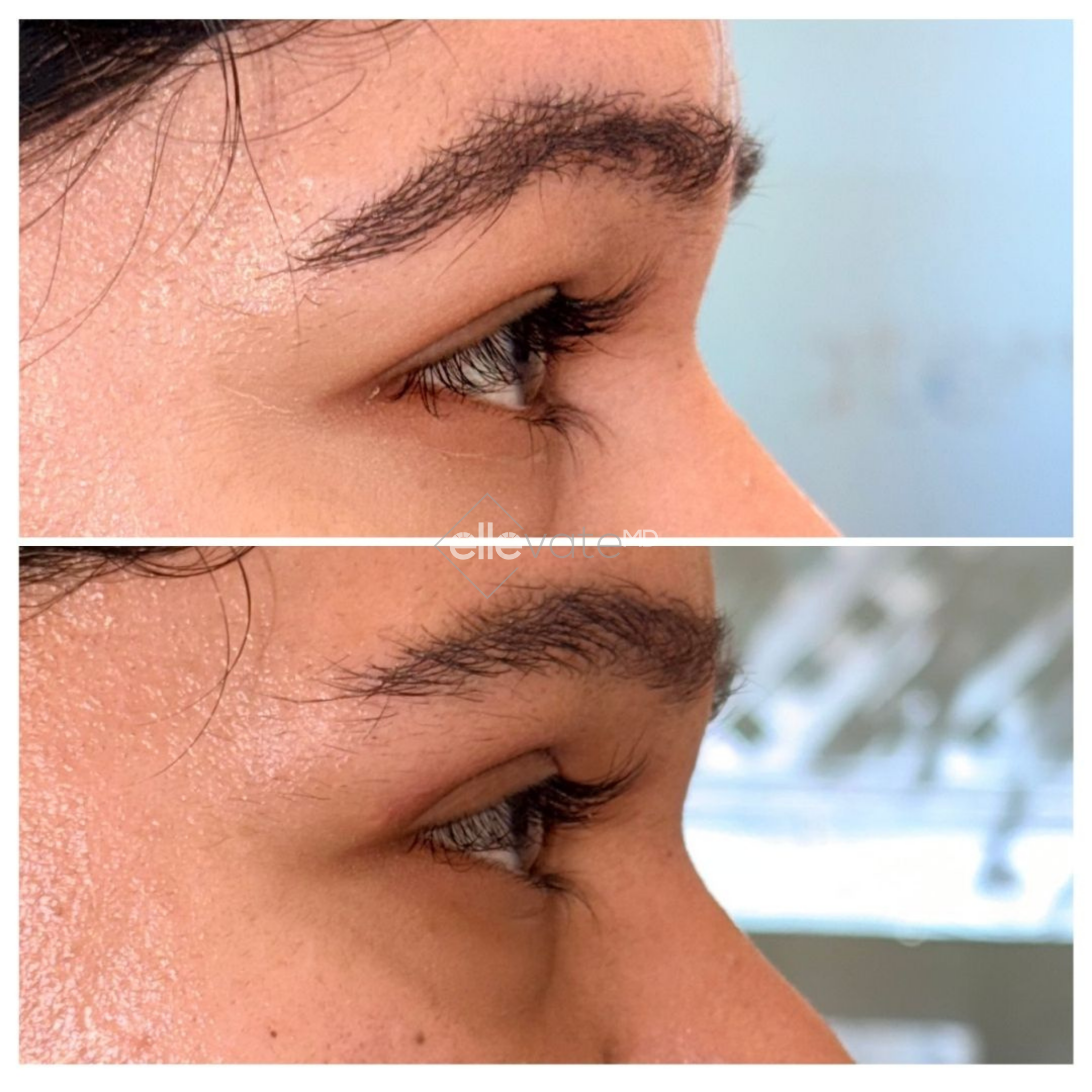 Before and after side profile of eye area showing reduced under-eye hollowing and improved skin texture