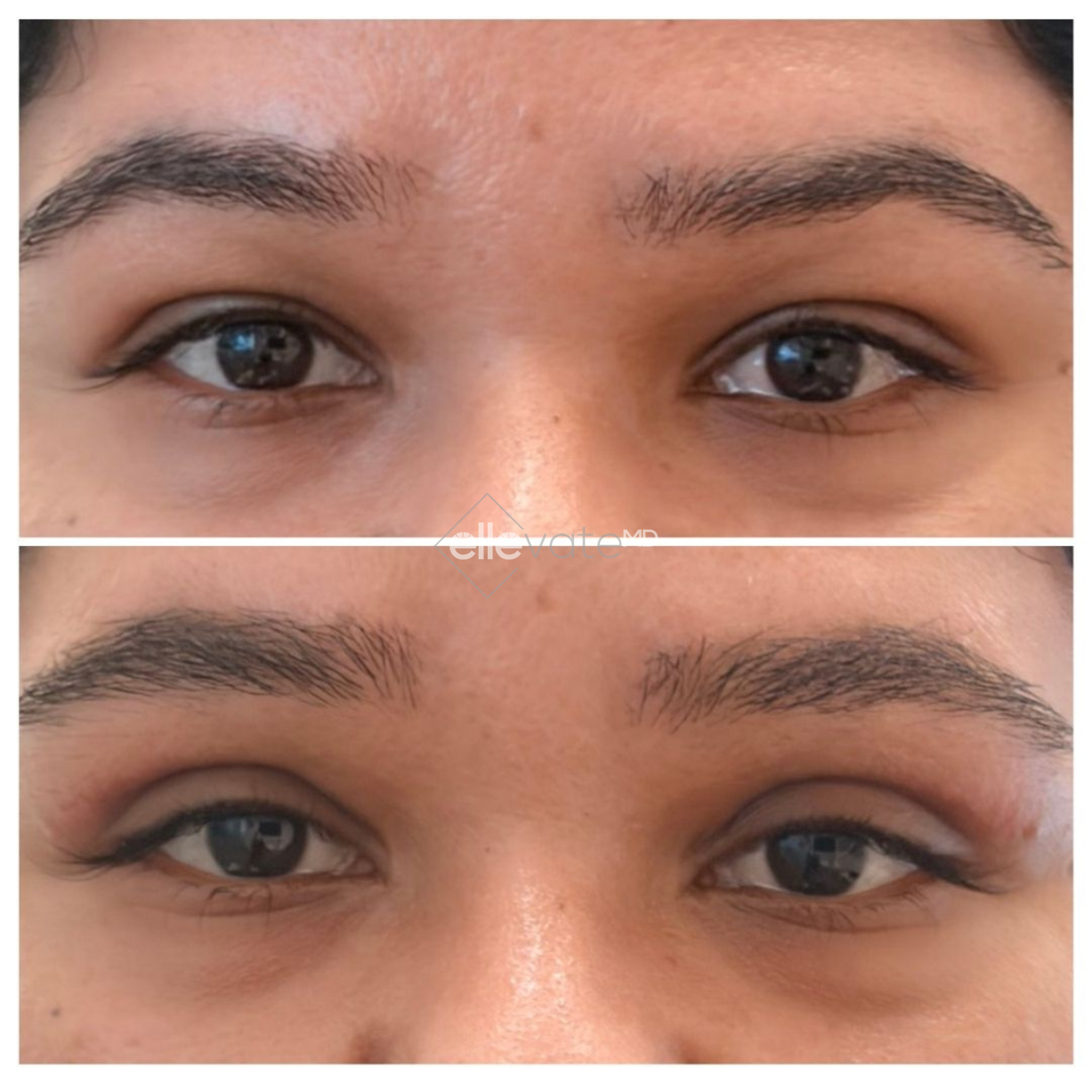 Before and after frontal view of eyes showing reduced under-eye bags and improved eyelid contour