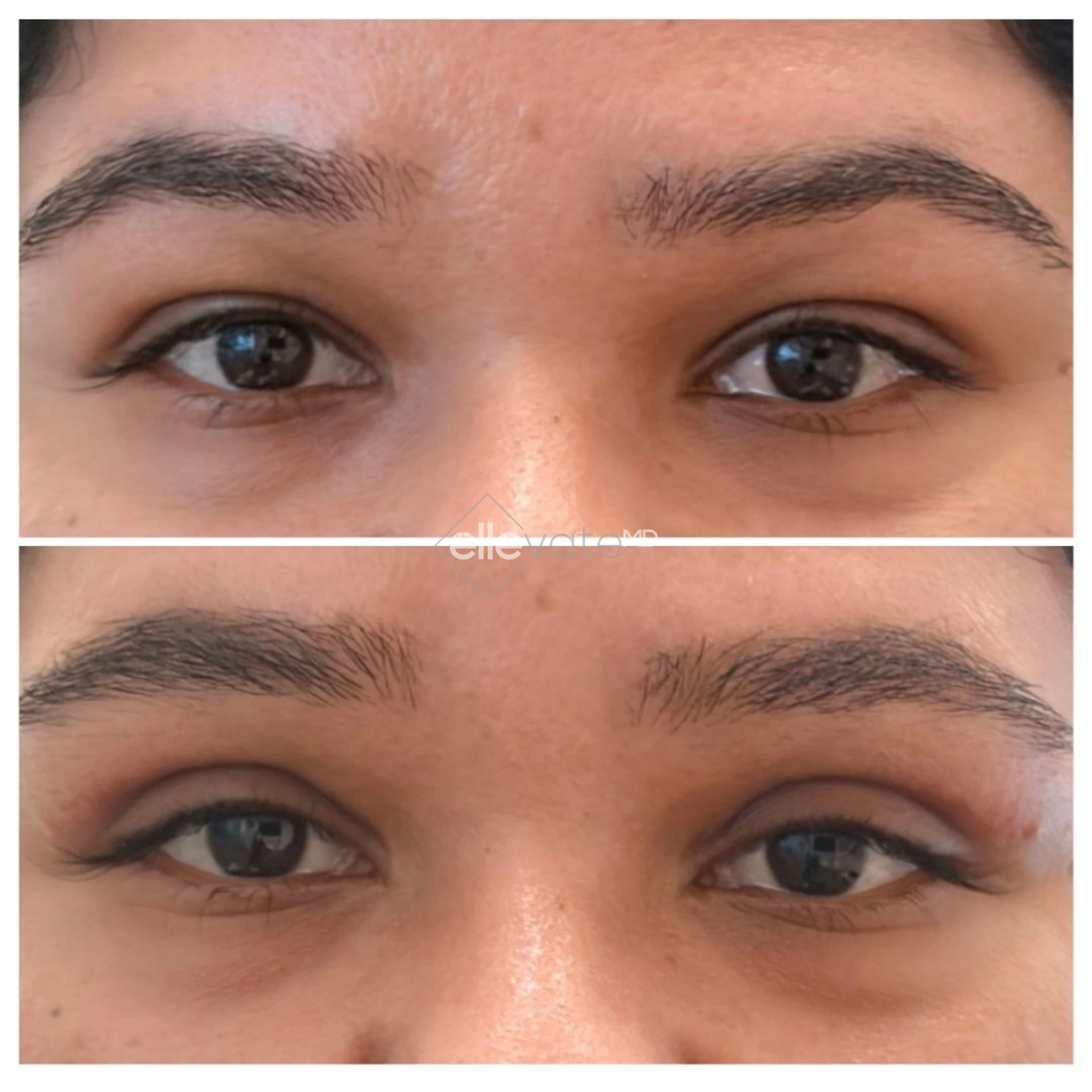 Before and after frontal view of eyes showing reduced under-eye bags and improved eyelid contour