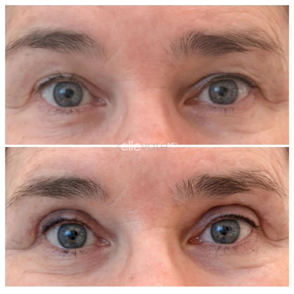 Before and after frontal view of eyes showing lifted eyelids and reduced periorbital wrinkles