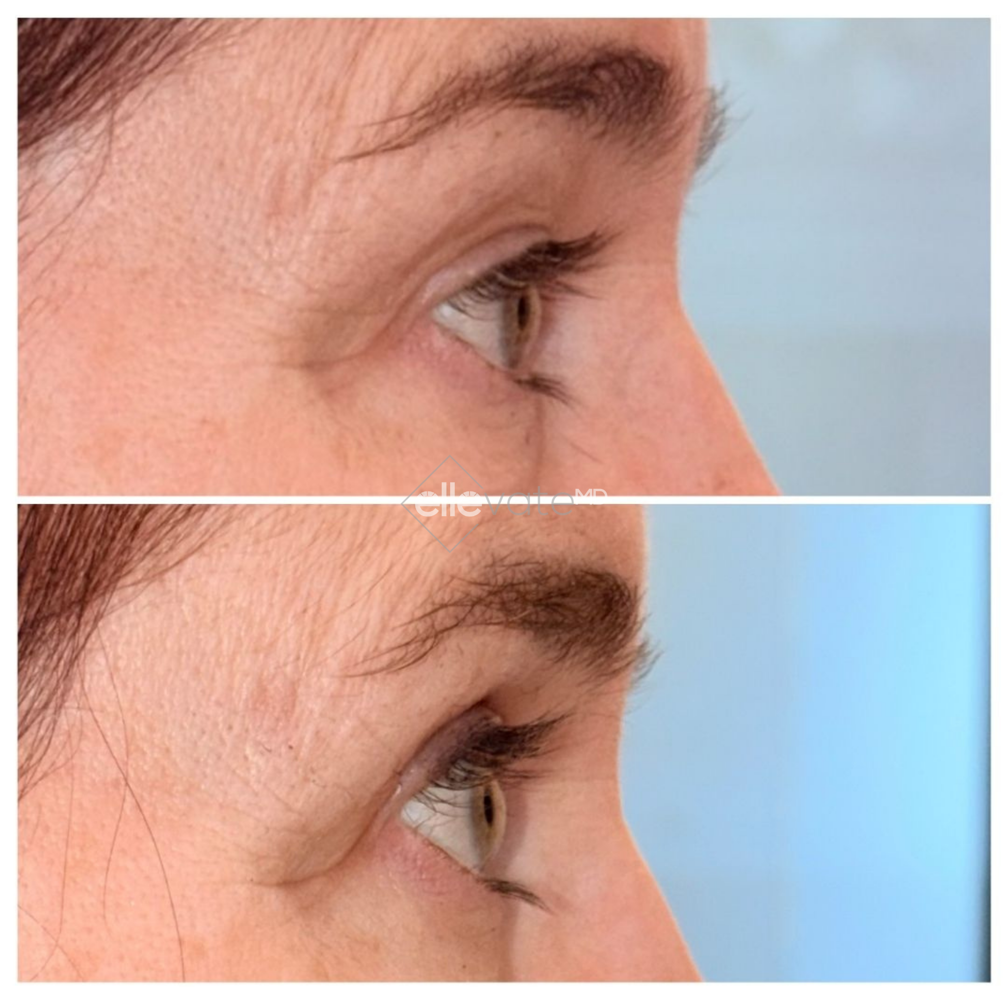 Before and after side profile of eye area showing improved eyelid lift and reduced sagging