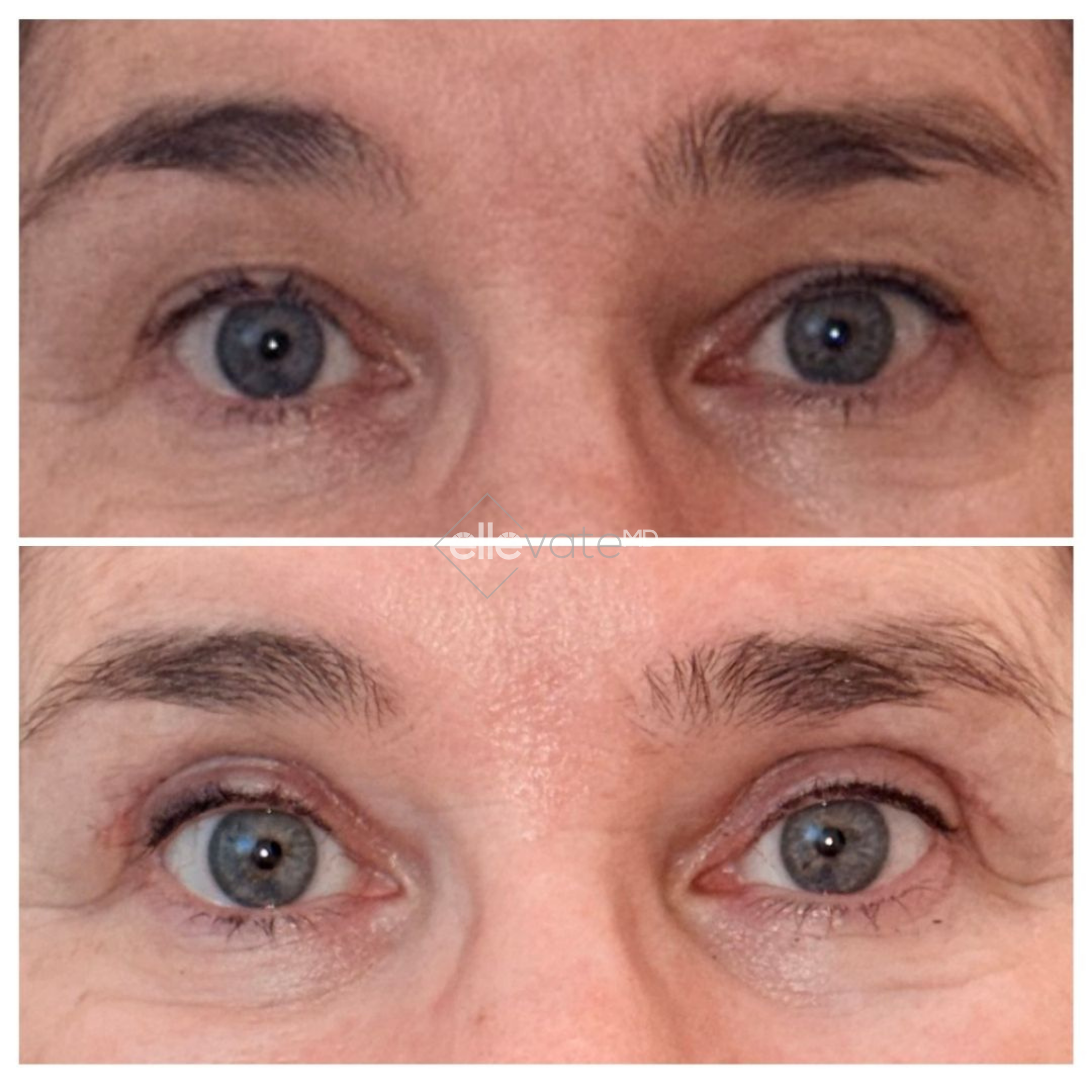Before and after frontal view of eyes showing reduced crow's feet and improved upper eyelid definition