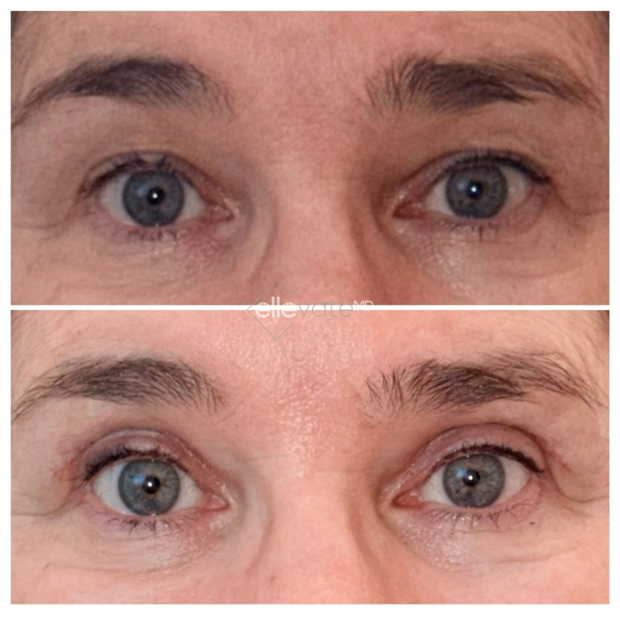 Before and after frontal view of eyes showing reduced crow's feet and improved upper eyelid definition