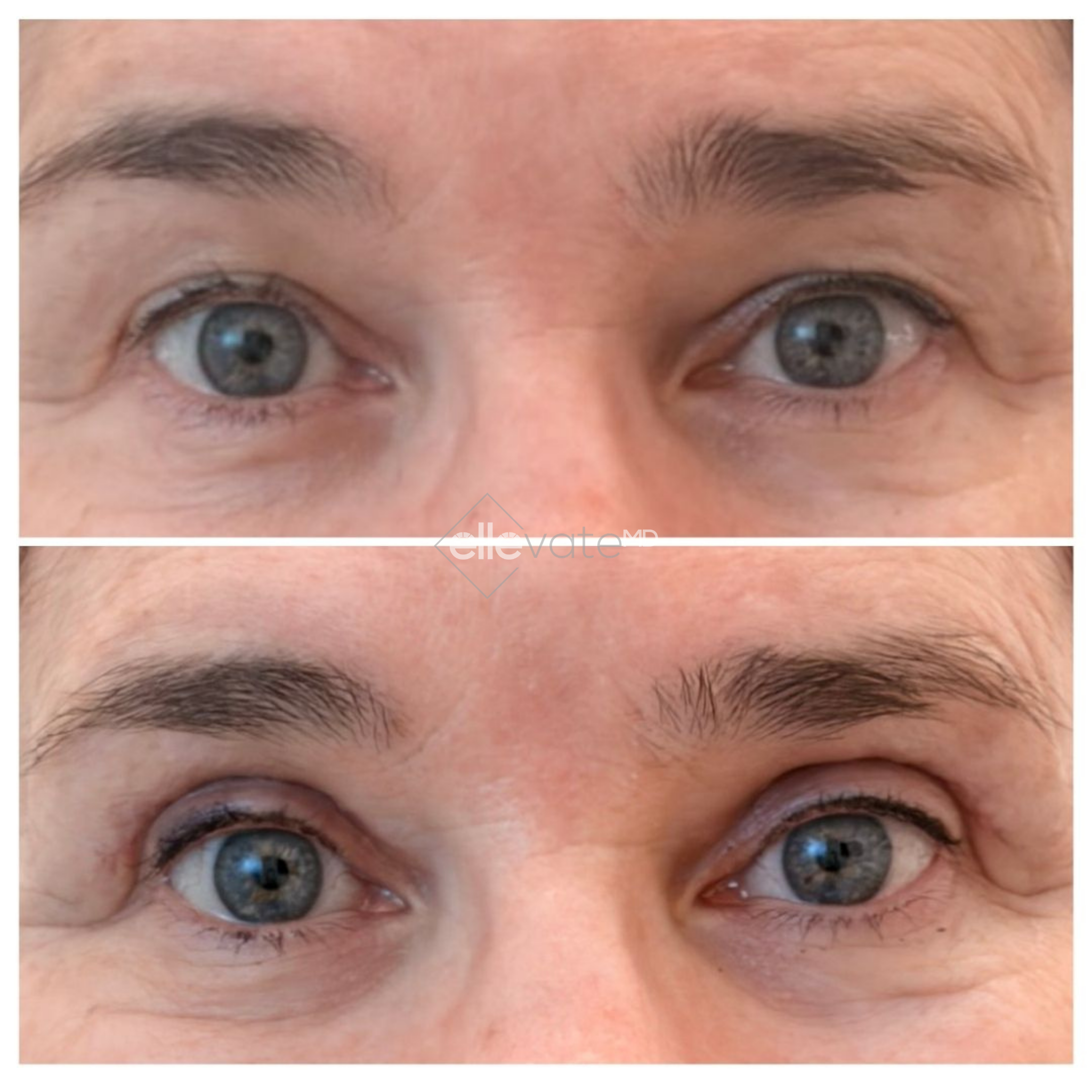 Before and after frontal view of eyes showing lifted eyelids and reduced periorbital wrinkles