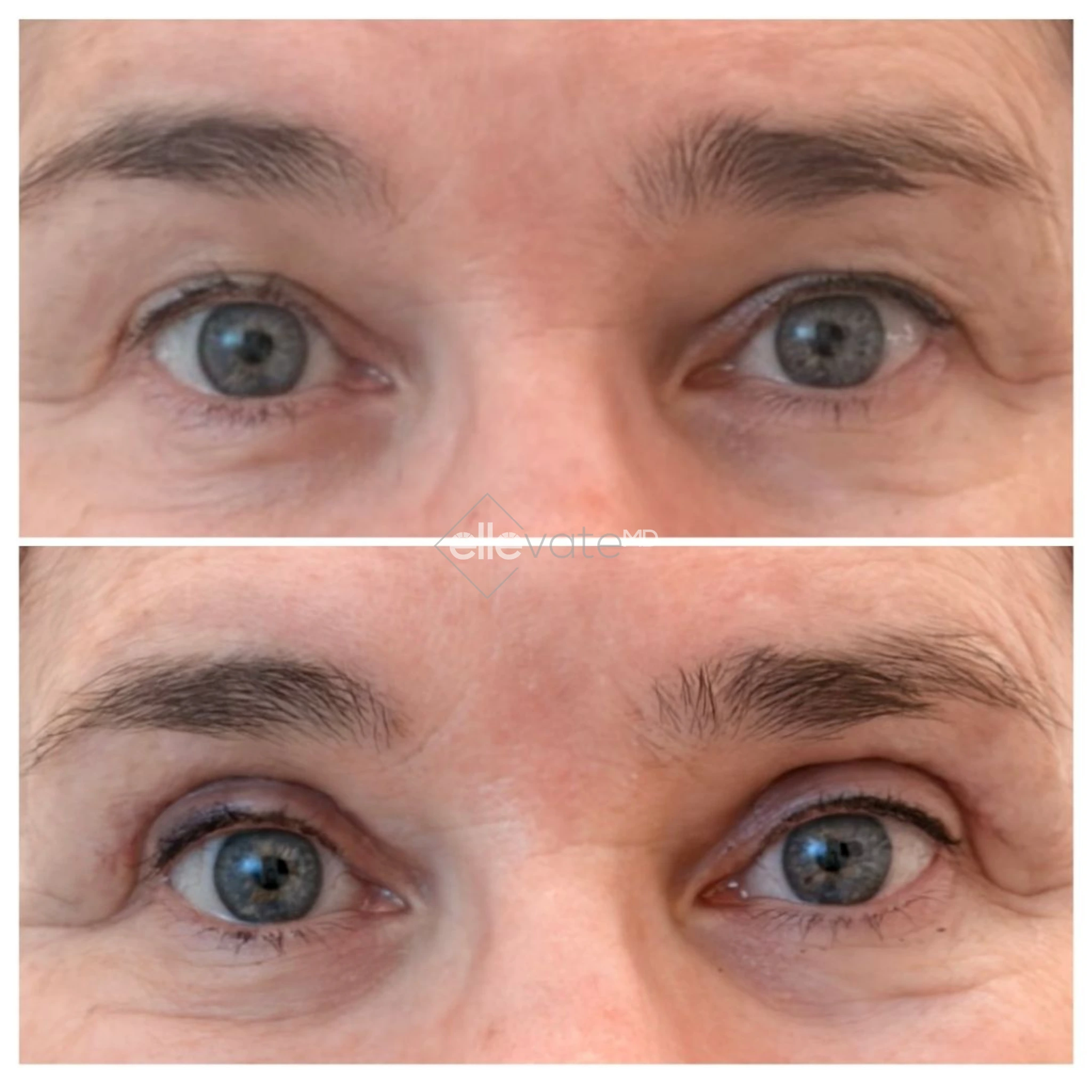 Before and after frontal view of eyes showing lifted eyelids and reduced periorbital wrinkles