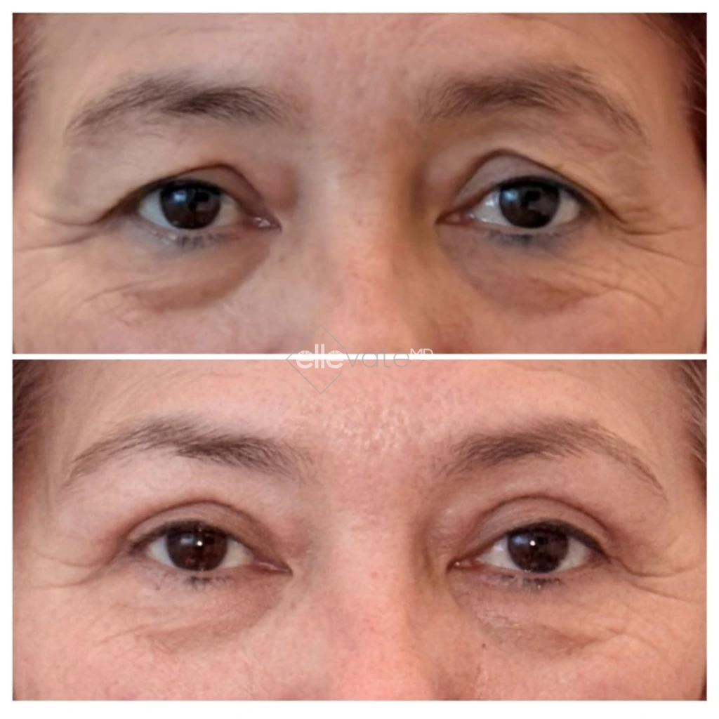 Before and after frontal view of eyes showing improved eyelid elevation and reduced under-eye fullness