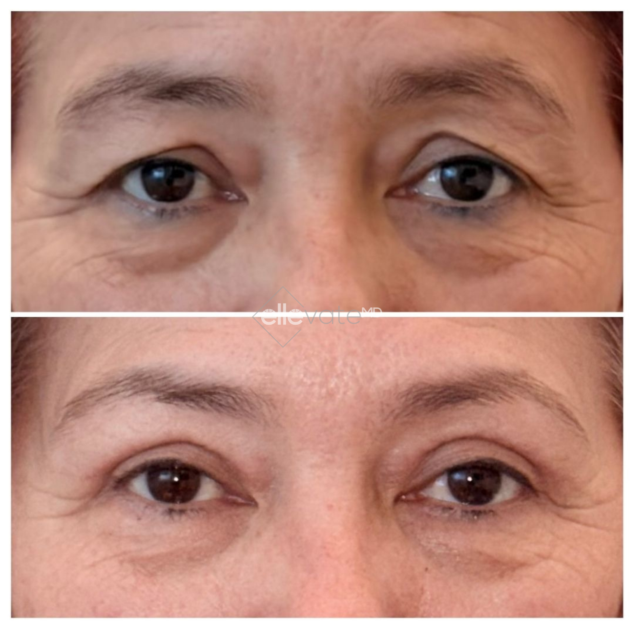 Before and after frontal view of eyes showing improved eyelid elevation and reduced under-eye fullness