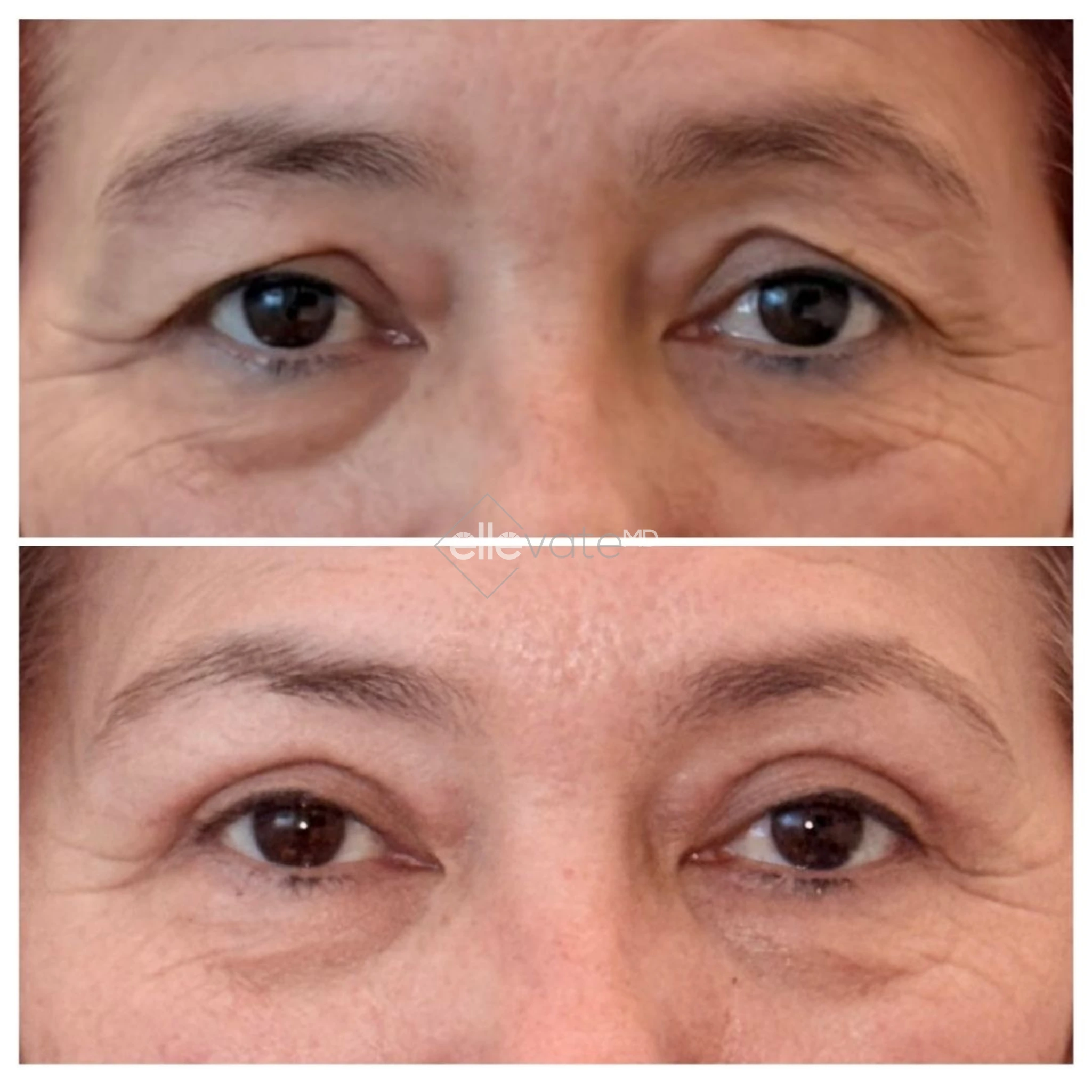 Before and after frontal view of eyes showing improved eyelid elevation and reduced under-eye fullness