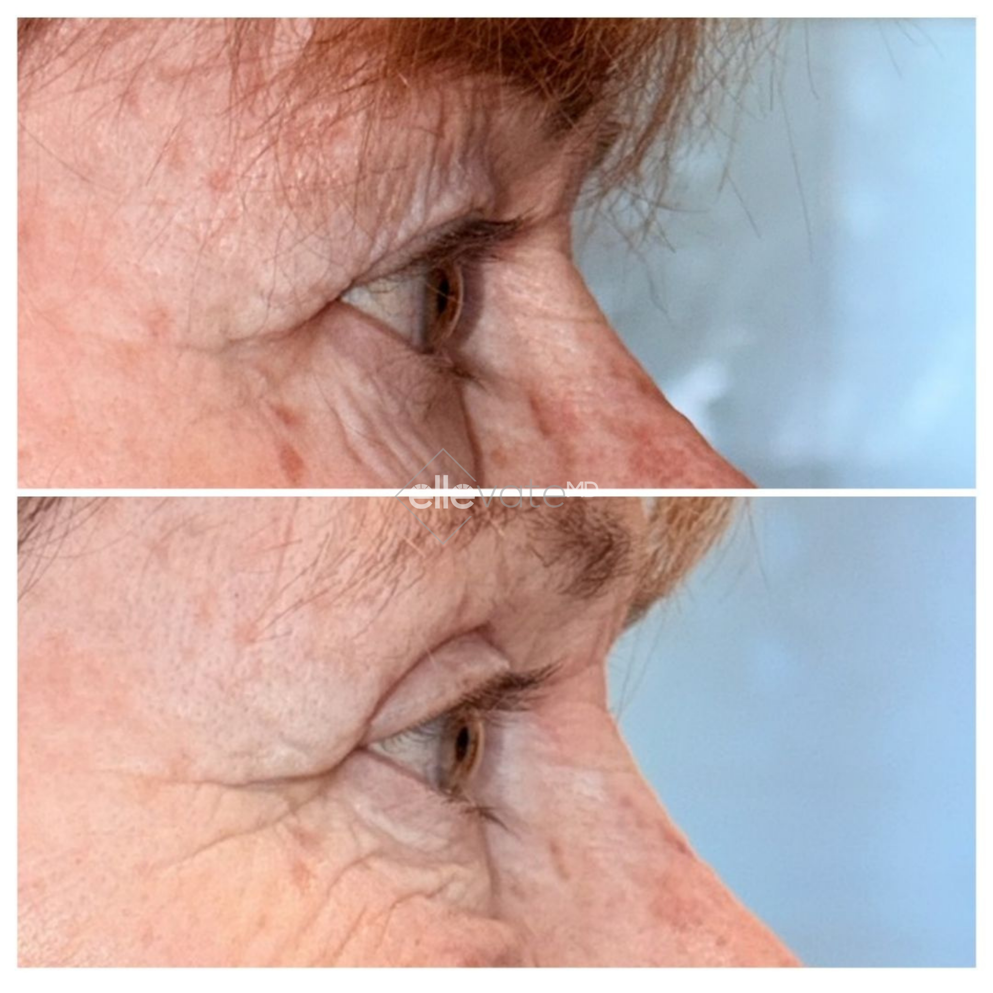 Before and after side profile showing neck and jawline definition improvement