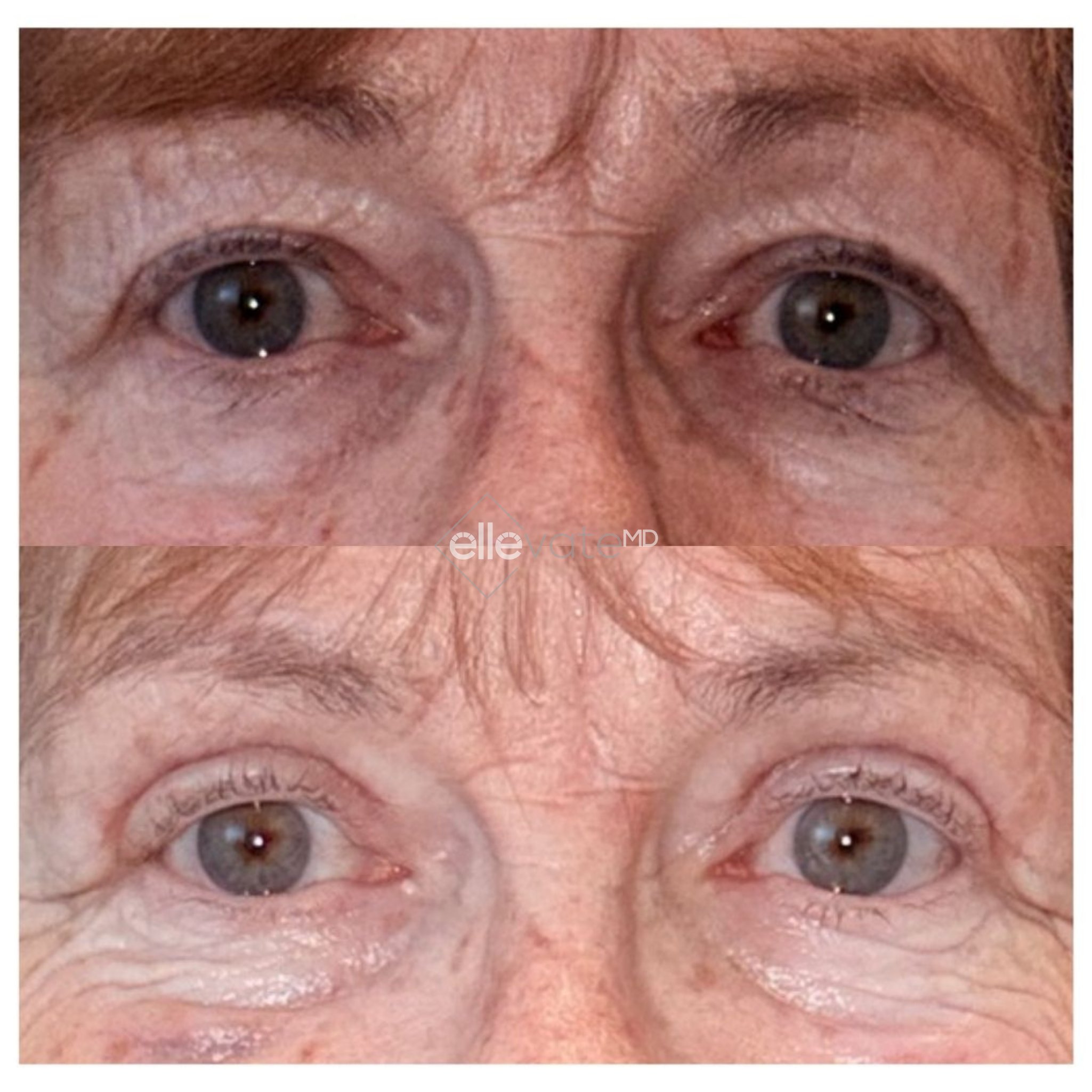 Before and after frontal view of eyes showing reduced under-eye hollowing and wrinkles