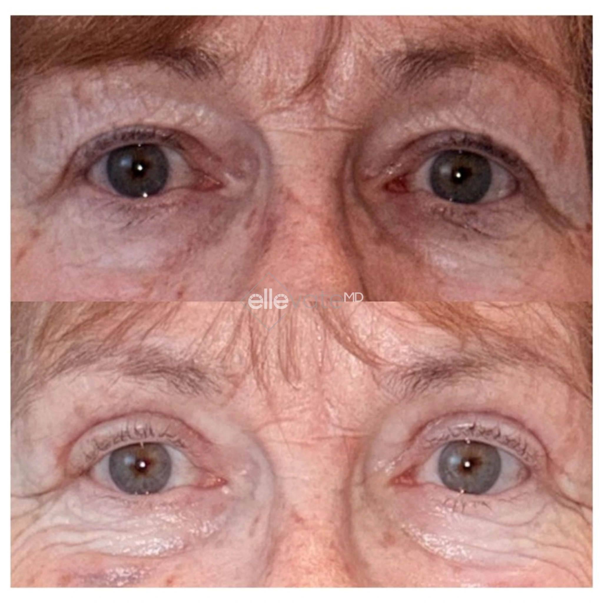 Before and after frontal view of eyes showing reduced under-eye hollowing and wrinkles