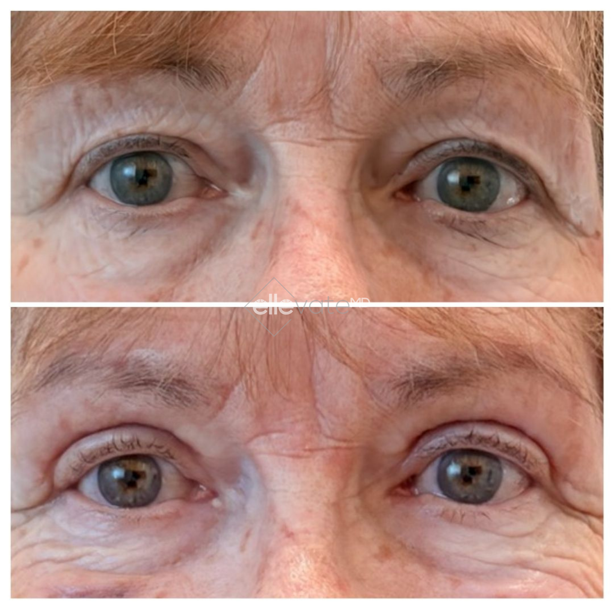Before and after frontal view of eyes showing improved eye lift and reduced sagging