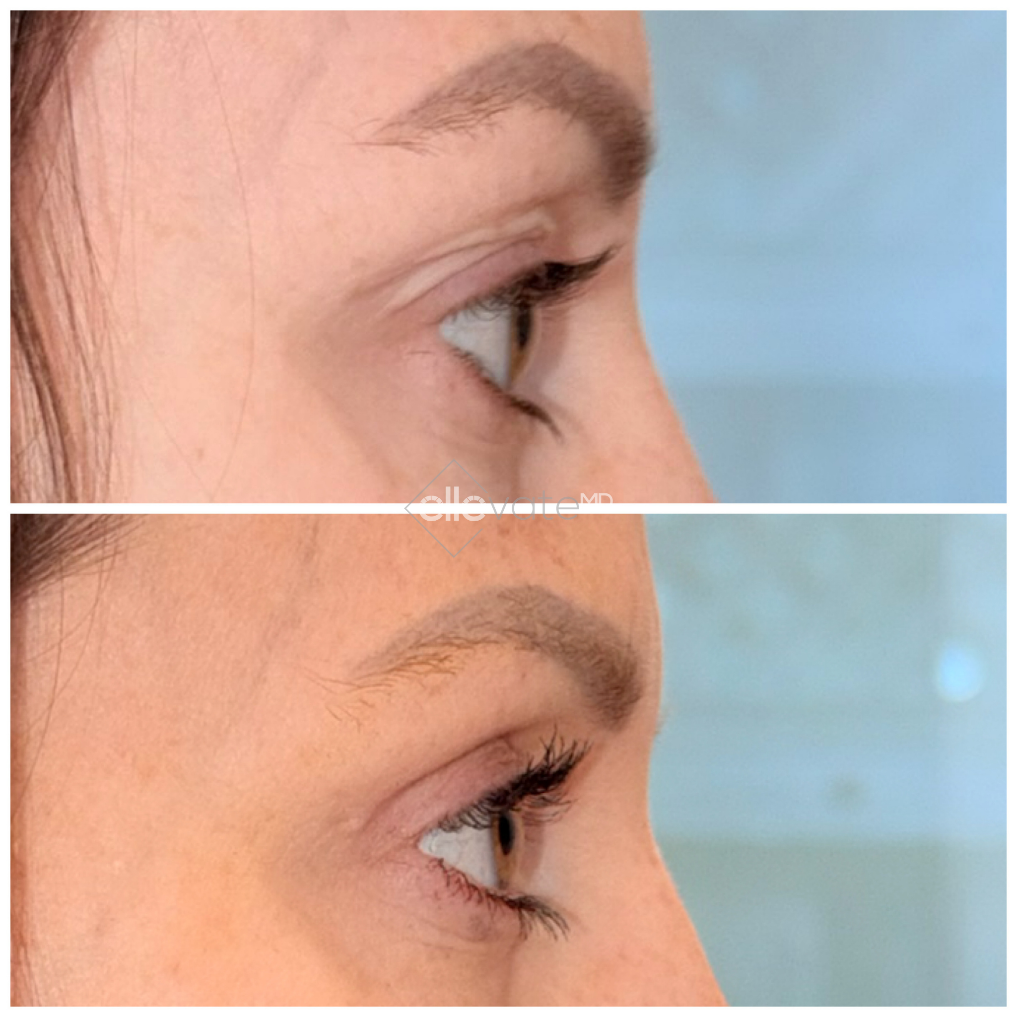 Before and after side profile showing improved nose-to-lip angle and lip definition