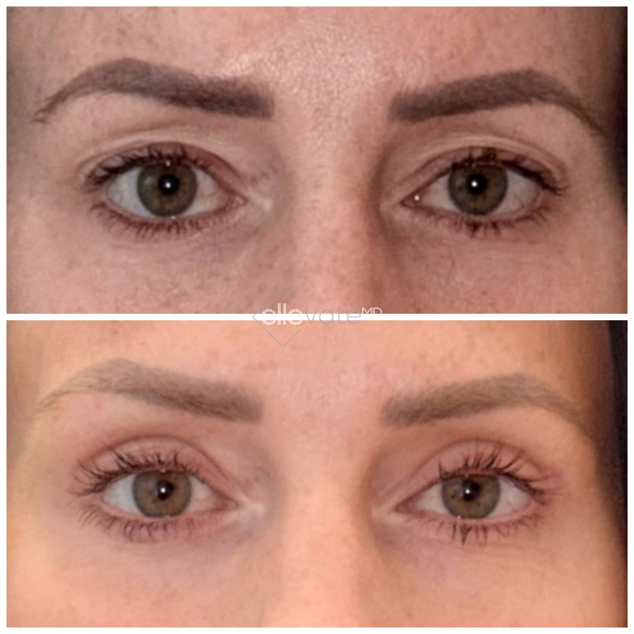 Before and after frontal view of eyes showing lifted brows and reduced crow's feet