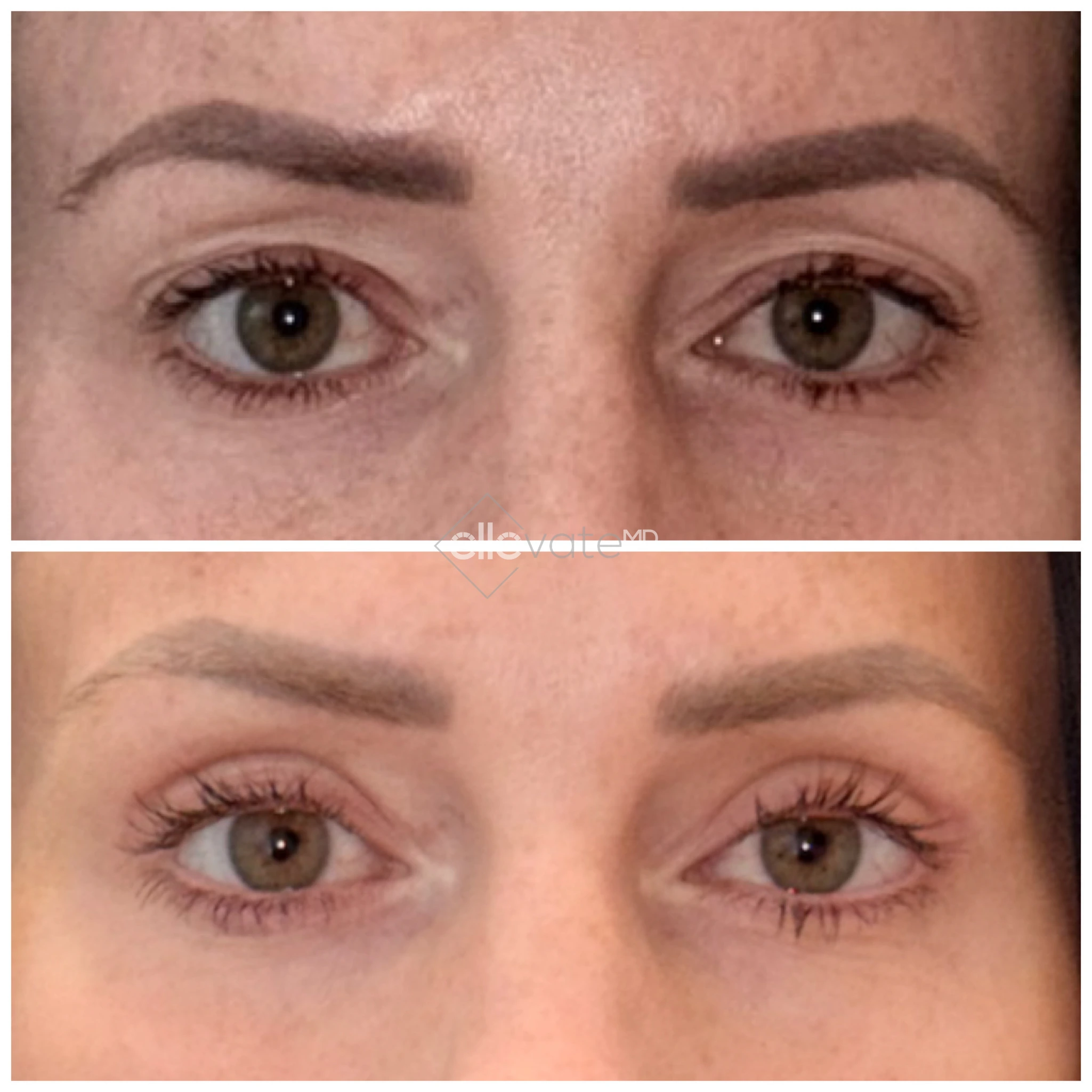 Before and after frontal view of eyes showing lifted brows and reduced crow's feet