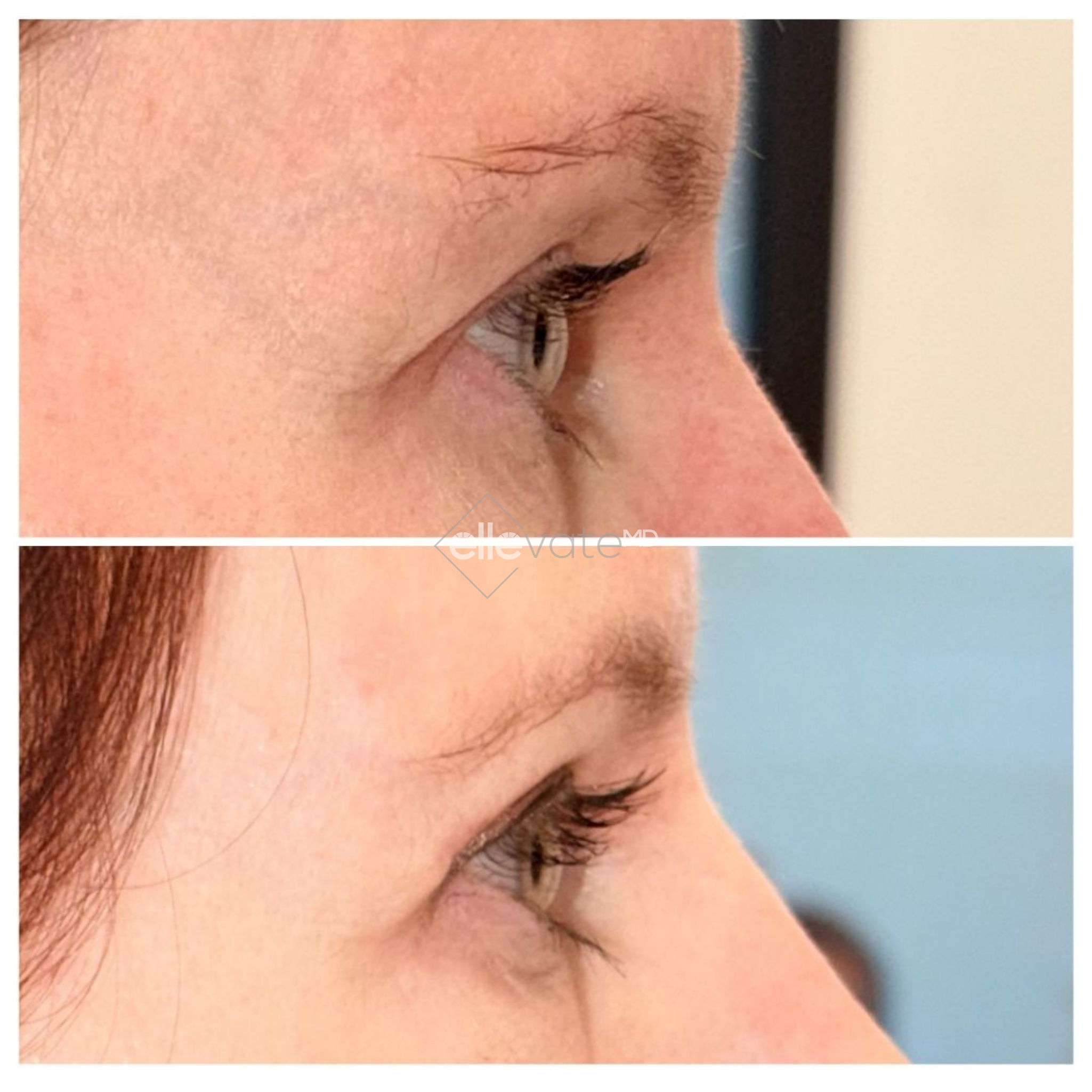 Before and after side profile showing improved eye contour and cheek projection