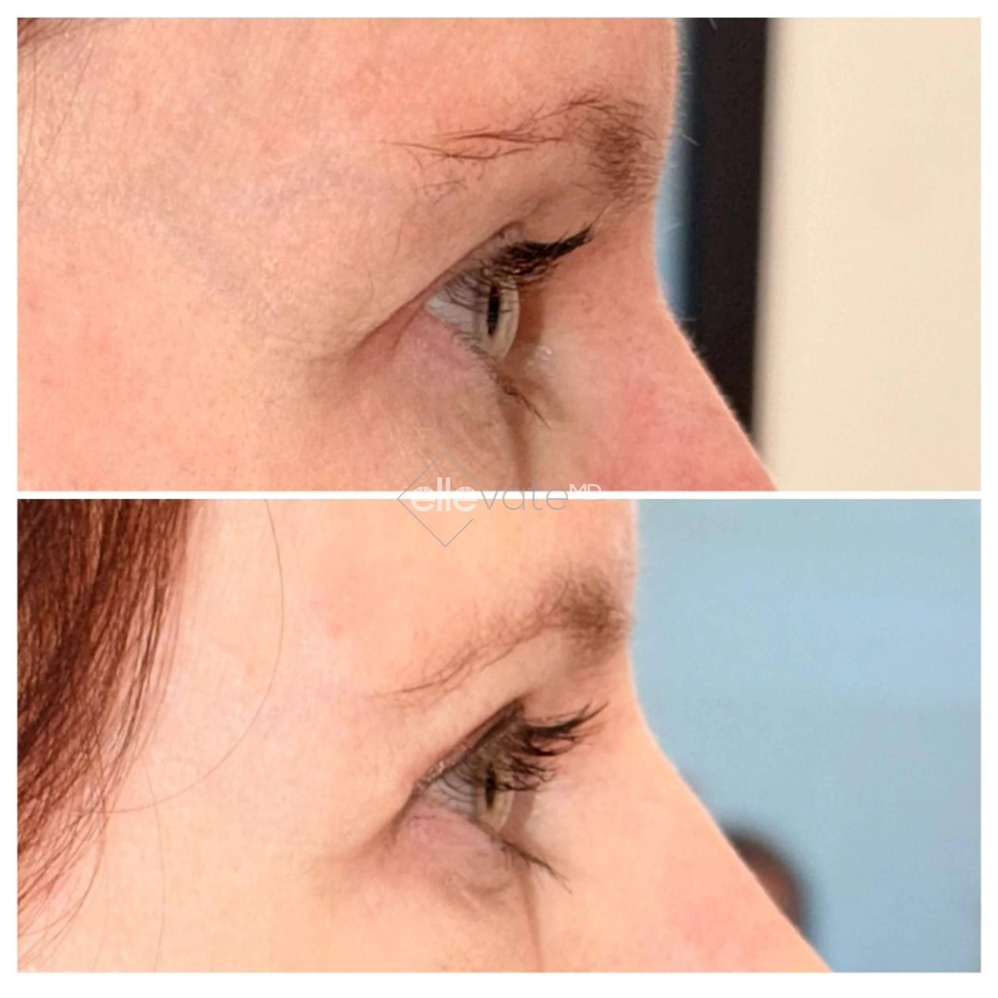 Before and after side profile showing improved eye contour and cheek projection