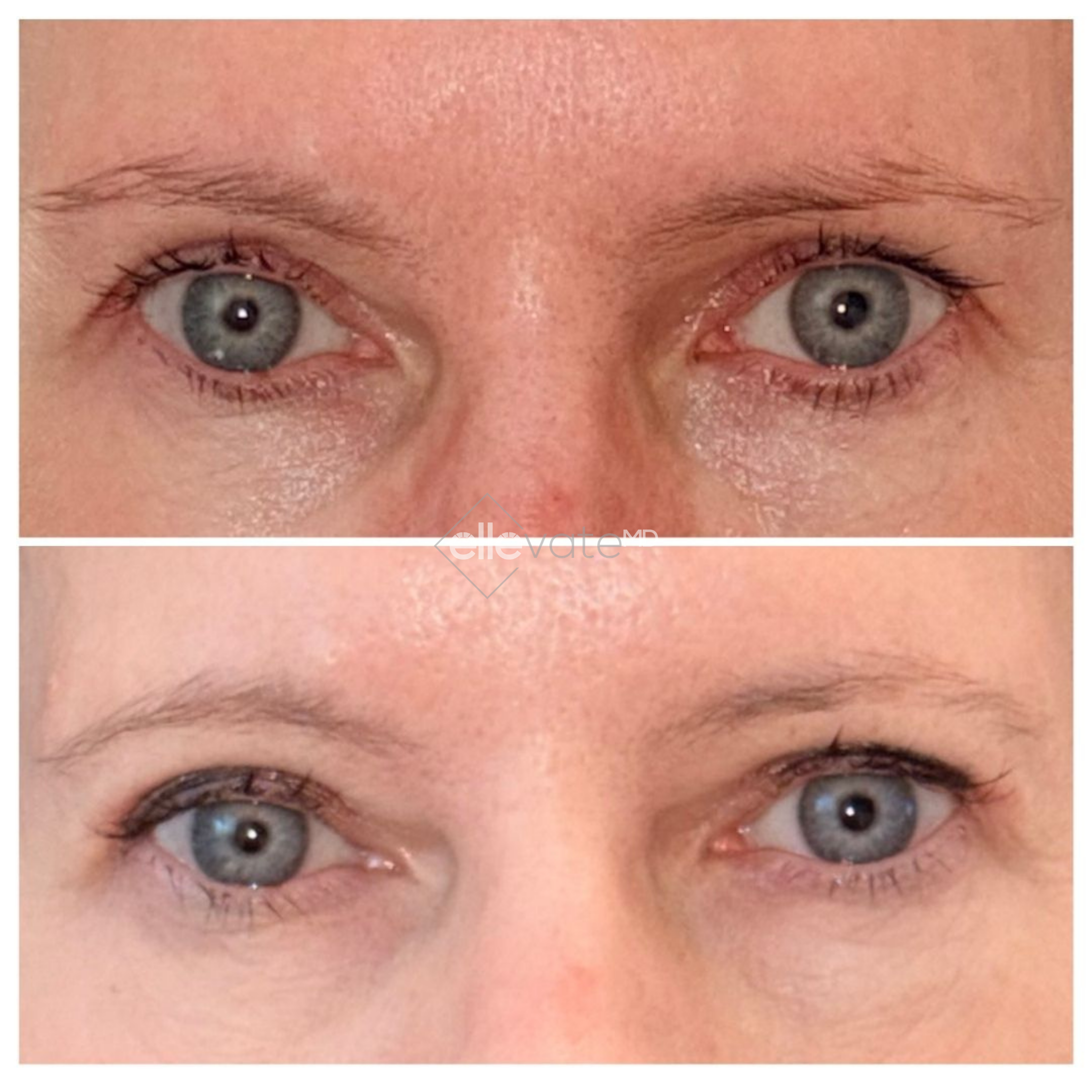 Before and after eye area showing reduced under-eye hollowing and improved skin texture