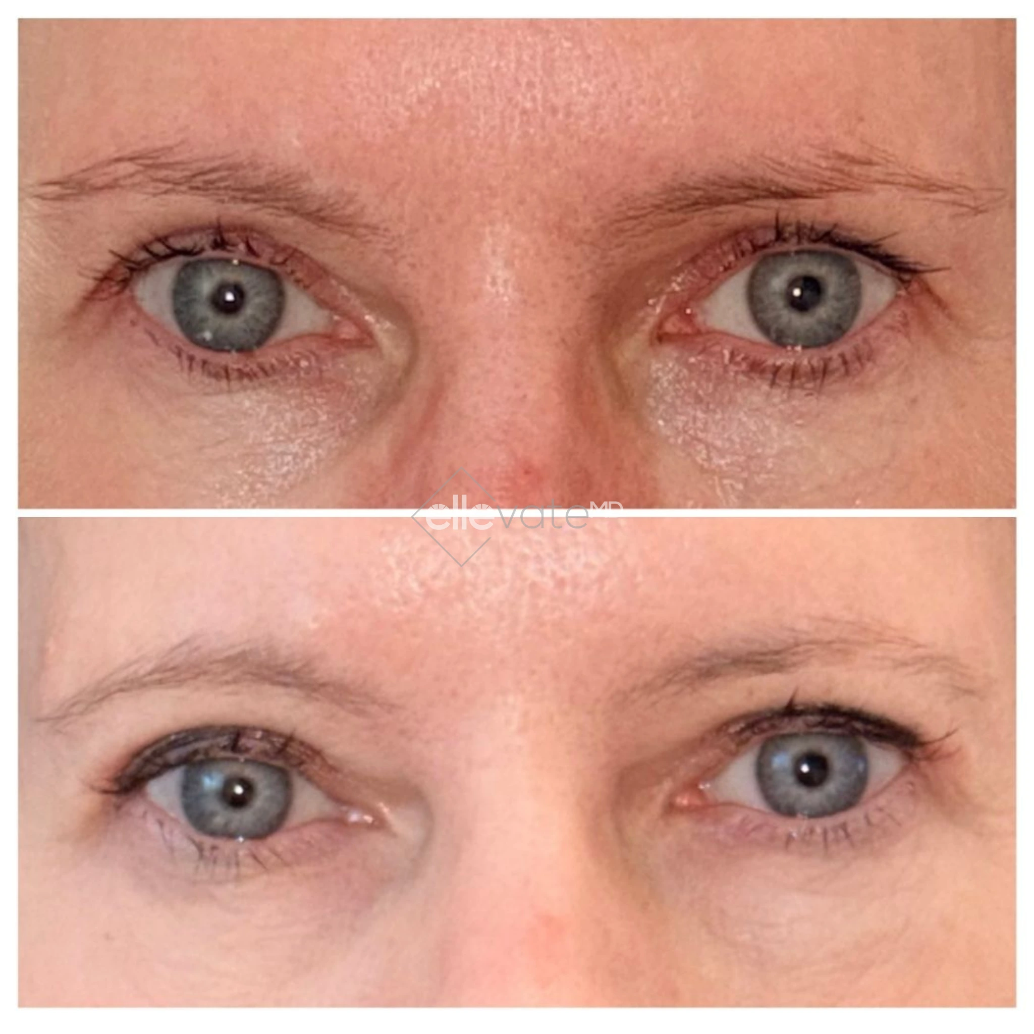 Before and after eye area showing reduced under-eye hollowing and improved skin texture