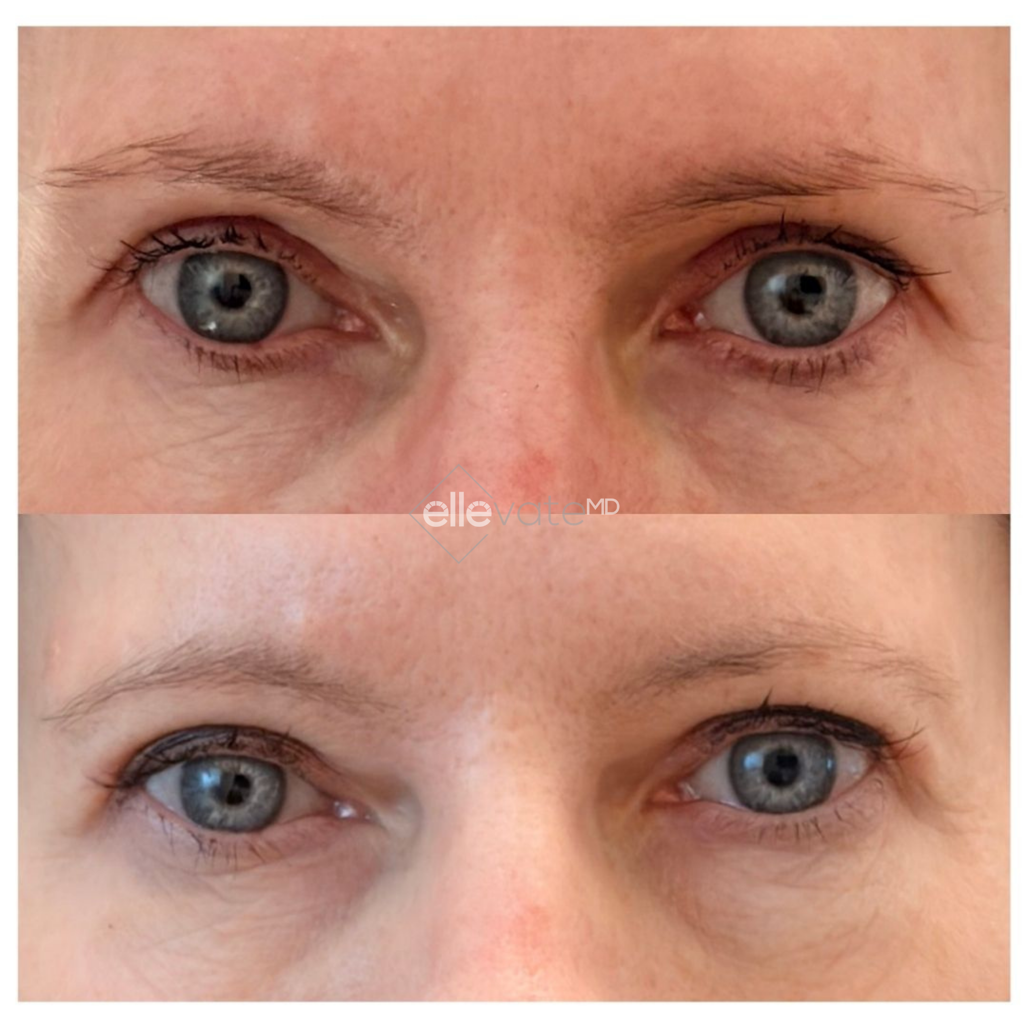 Before and after eye area showing improved under-eye volume and skin appearance