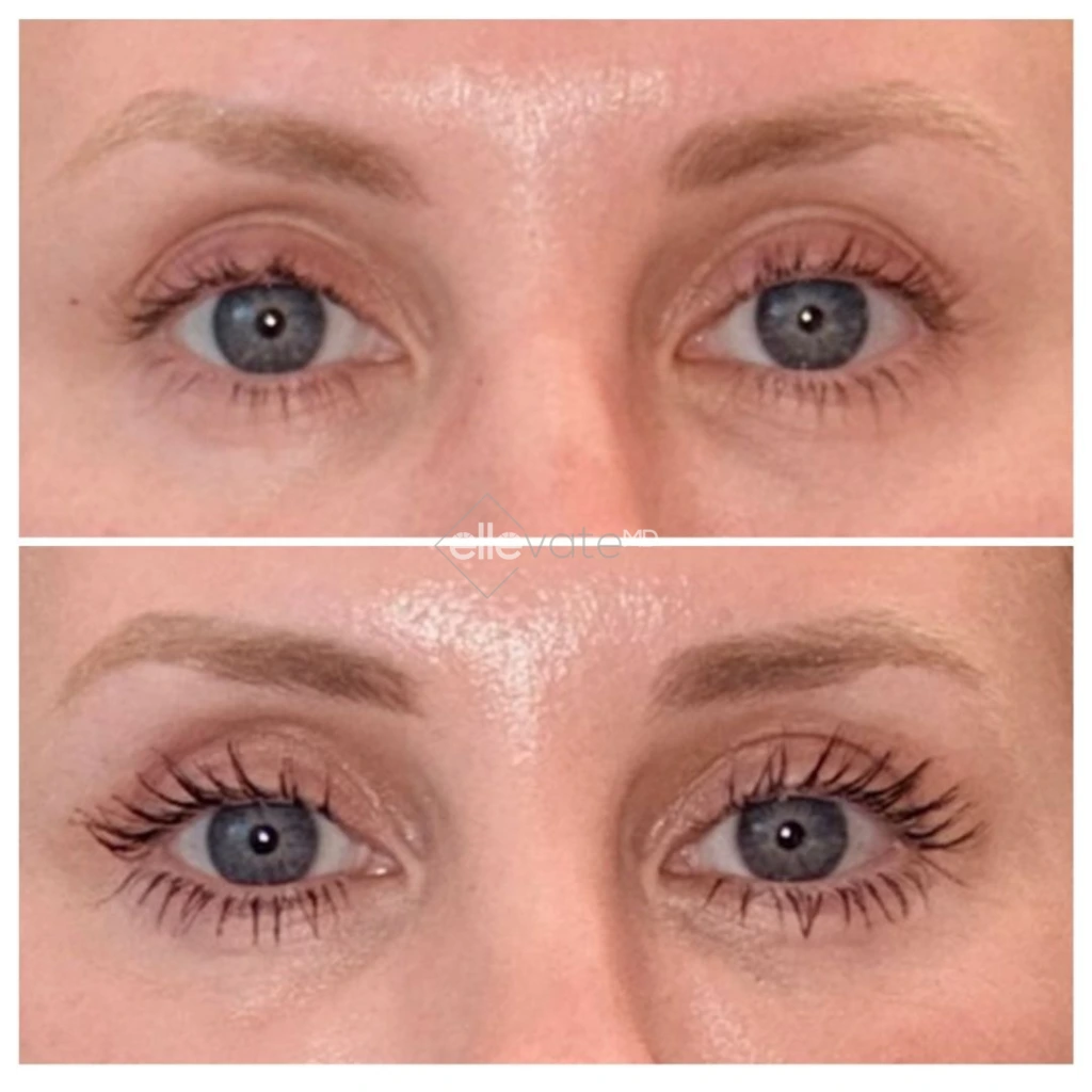 Before and after eye area showing enhanced eyelid lift and increased lash prominence