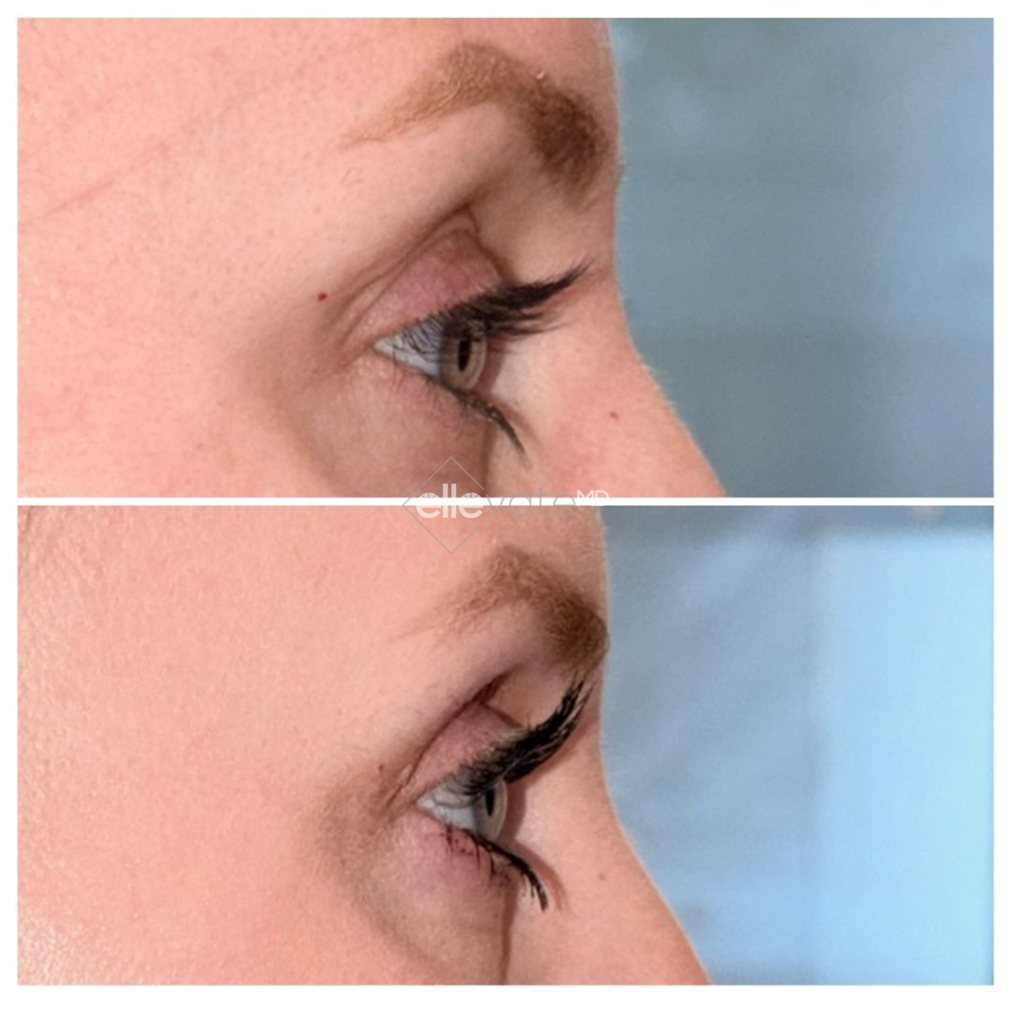 Before and after side profile showing improved lip definition and mouth contour