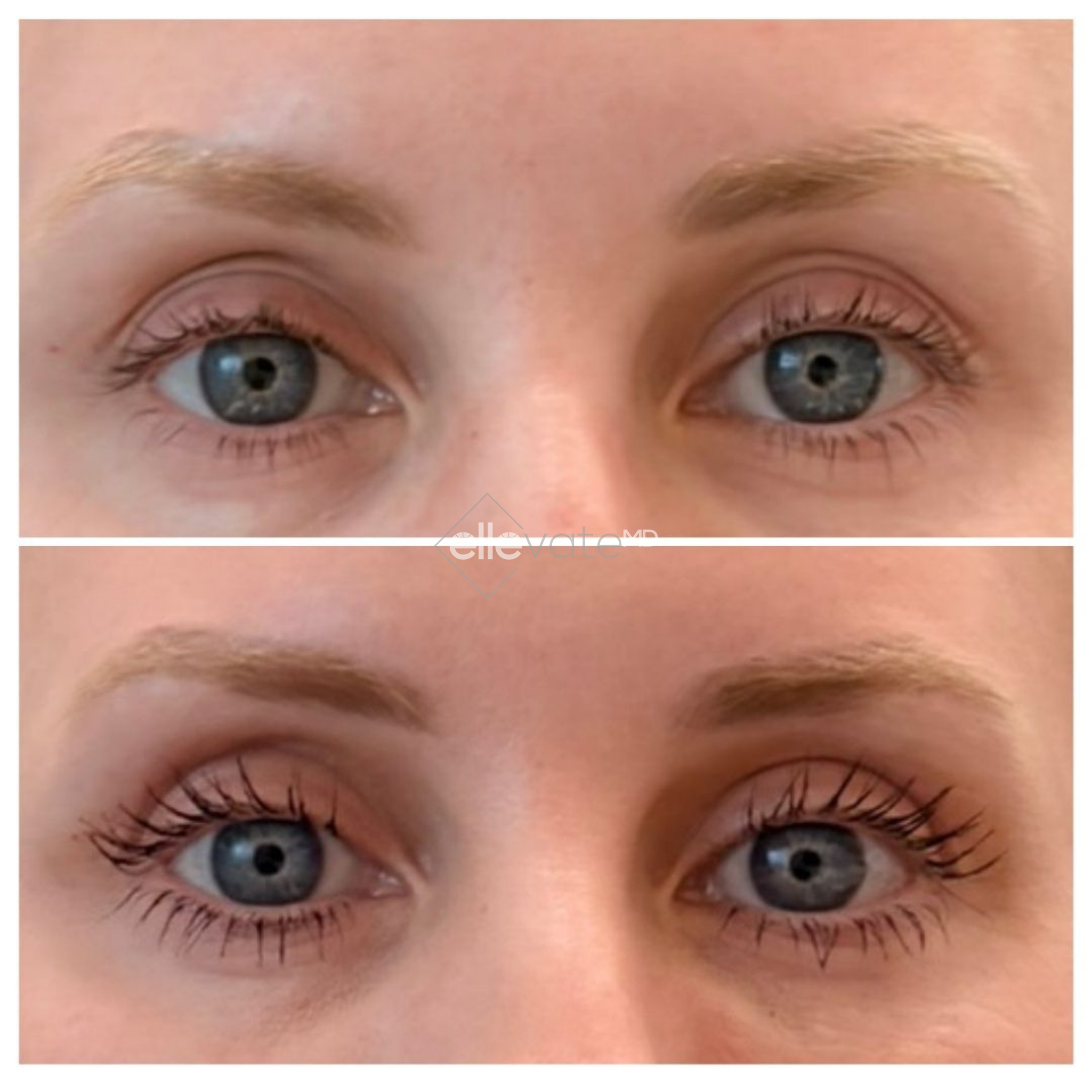 Before and after eye area showing improved upper eyelid fullness and lash definition