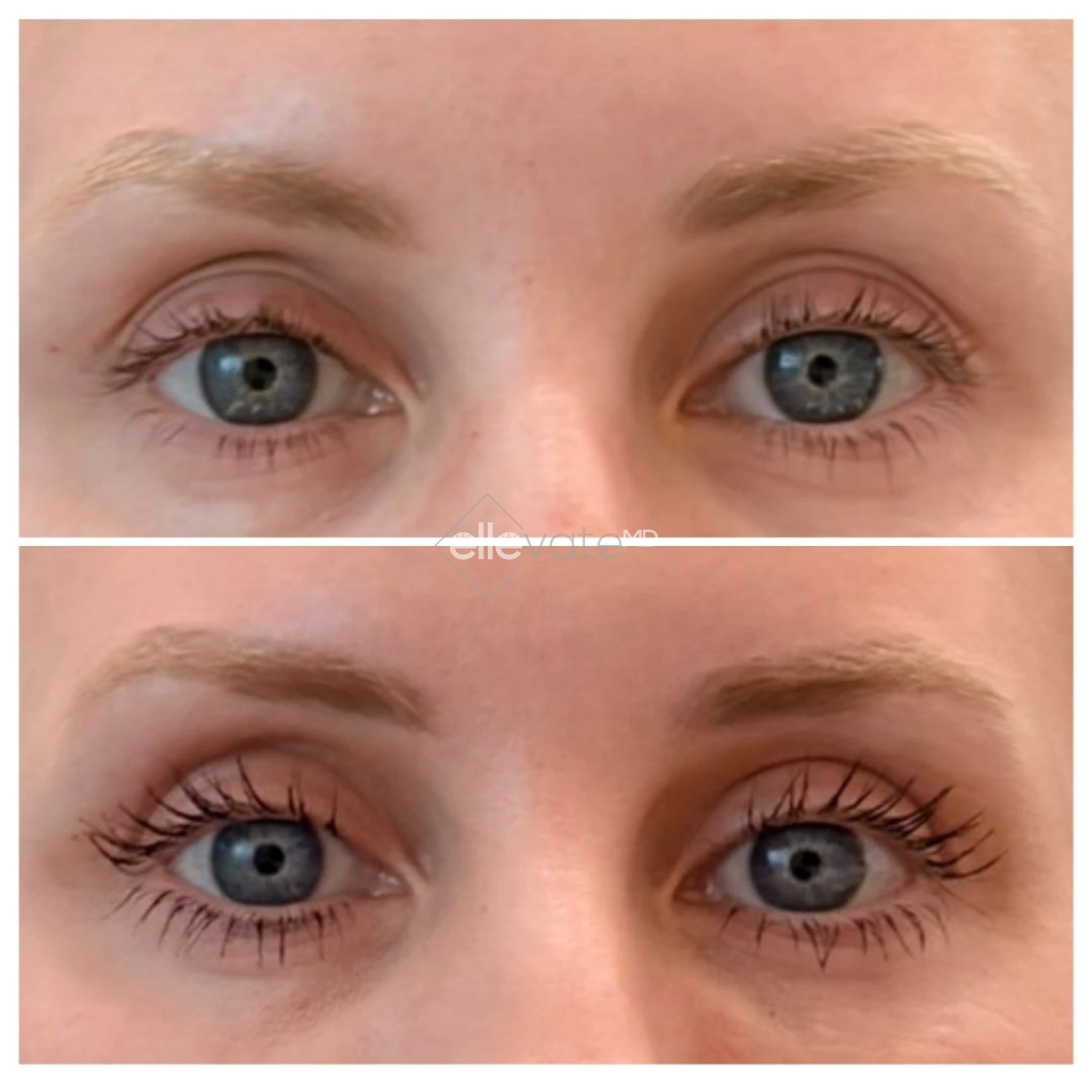Before and after eye area showing improved upper eyelid fullness and lash definition