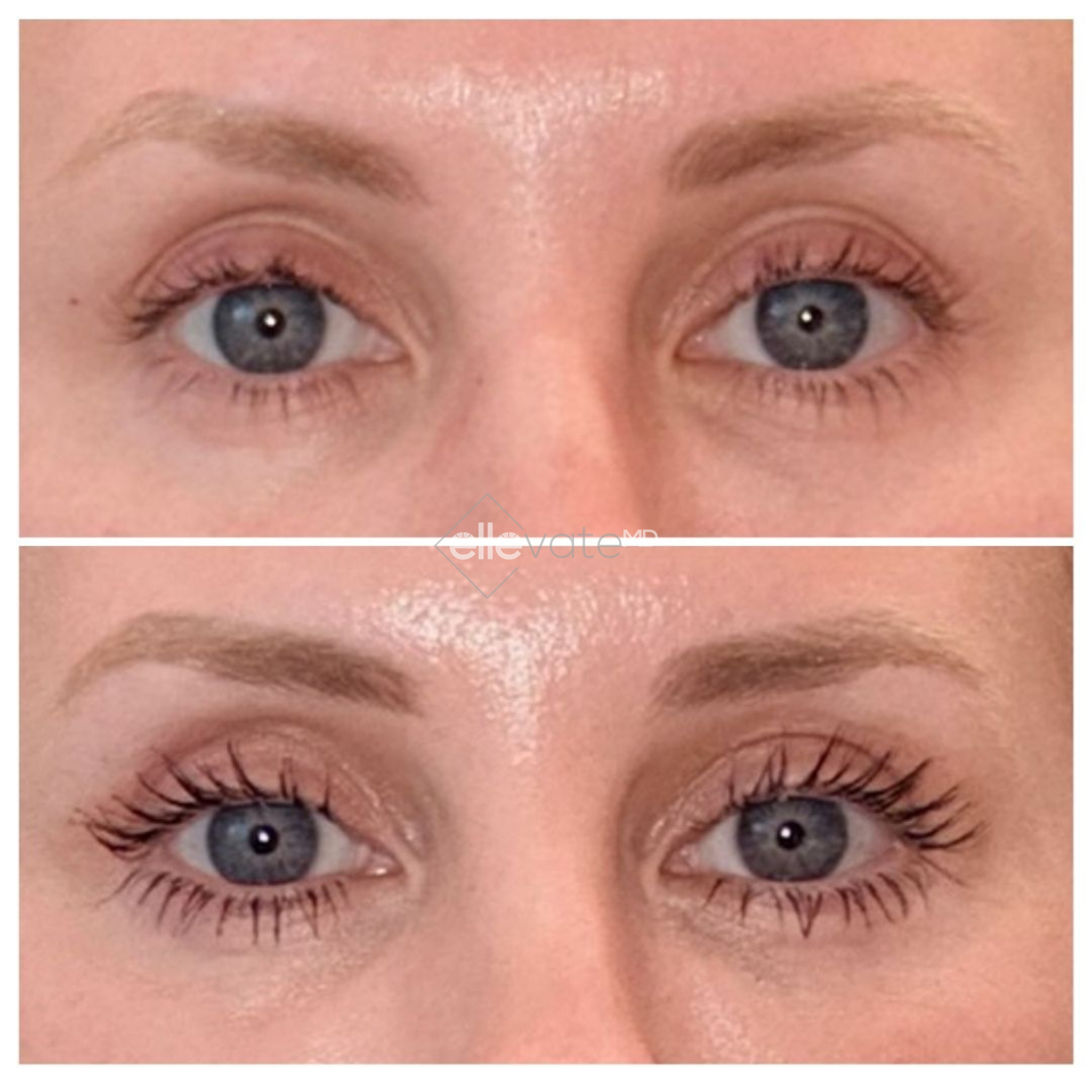 Before and after eye area showing enhanced eyelid lift and increased lash prominence