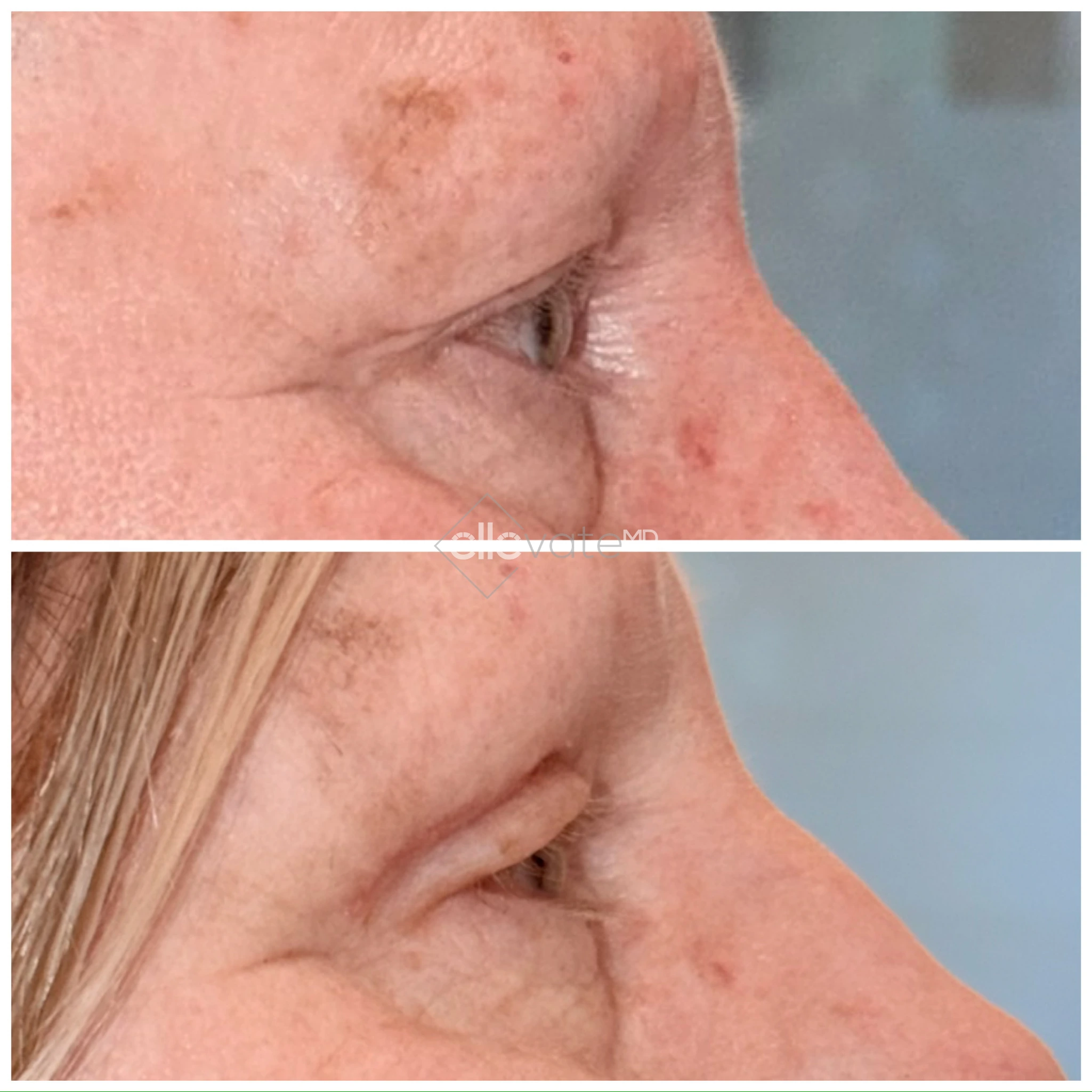 Before and after profile view of patient's upper eyelid and eye area from Upper Lid Lift treatment