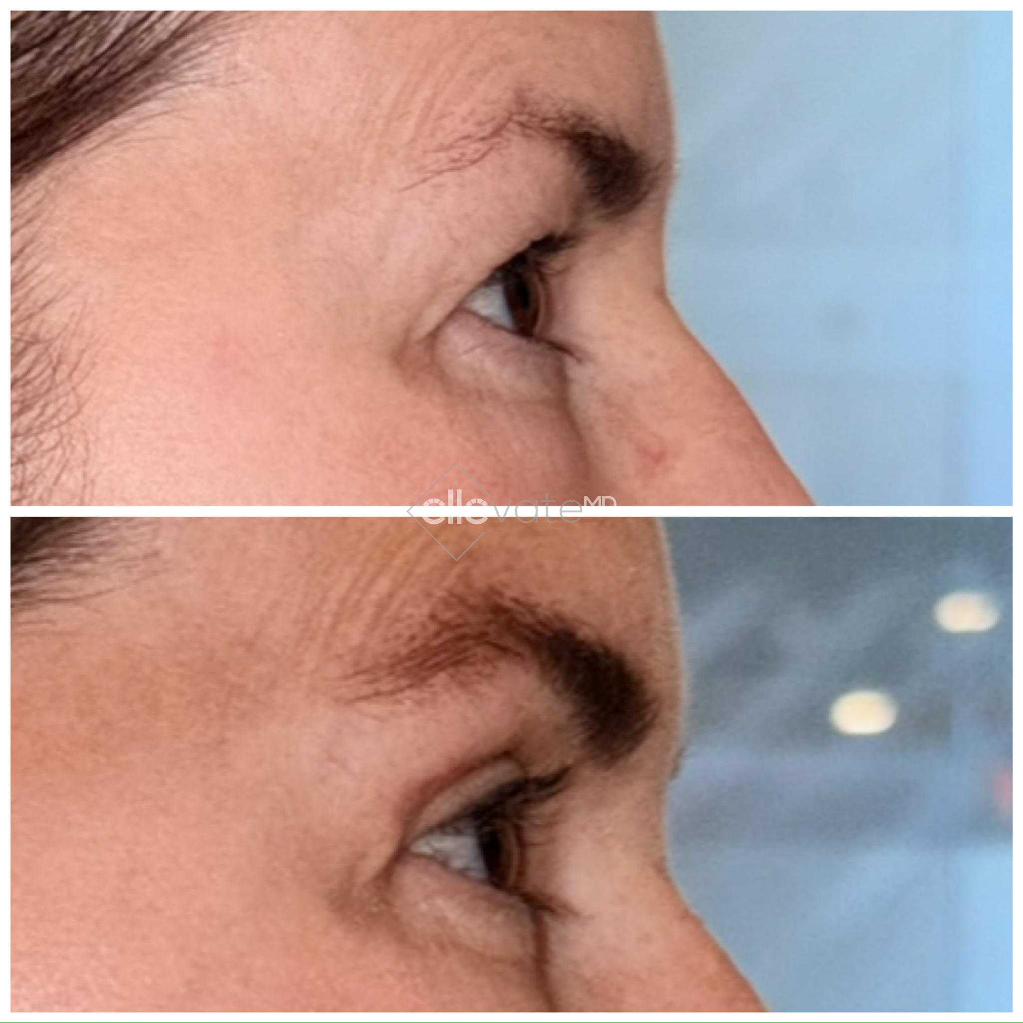 Before and after profile comparison of upper eyelid lift with enhanced upper lid elevation
