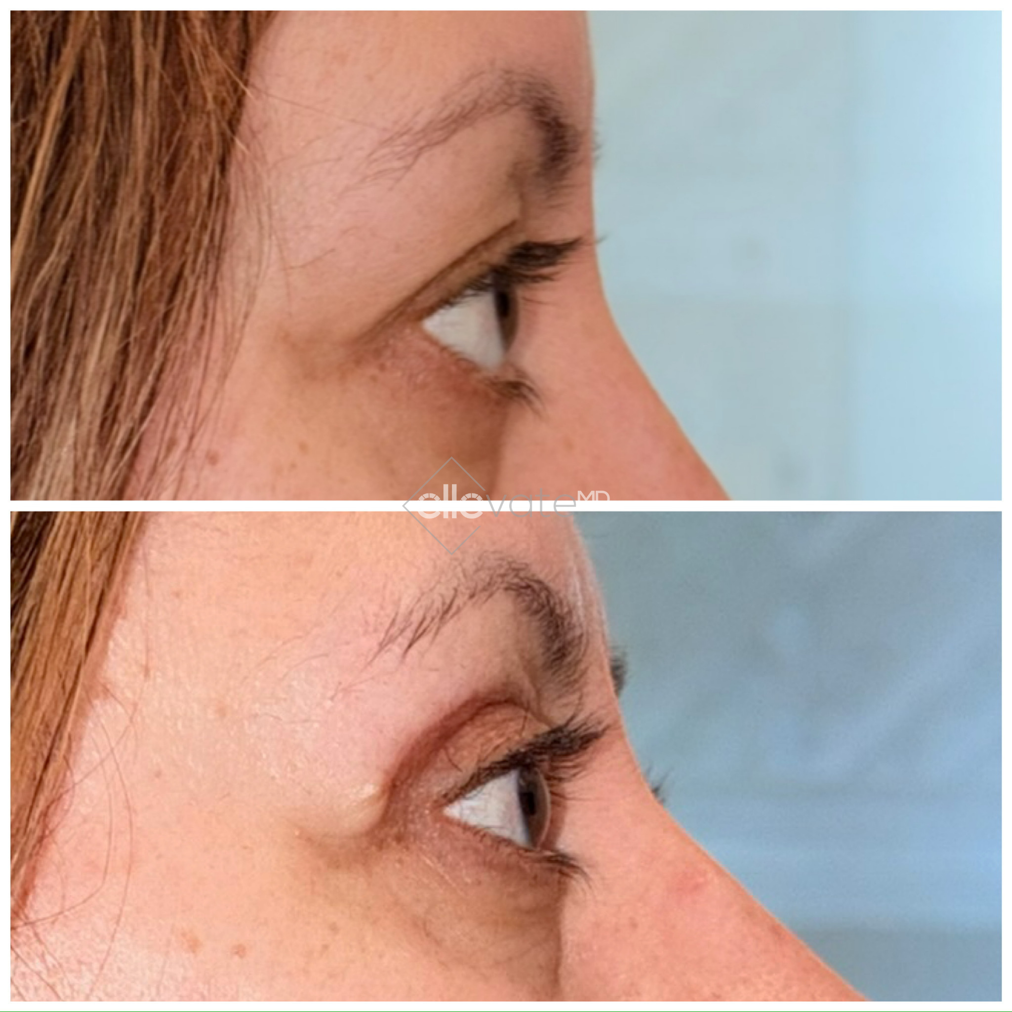 Before and after profile view of upper eyelid lift results