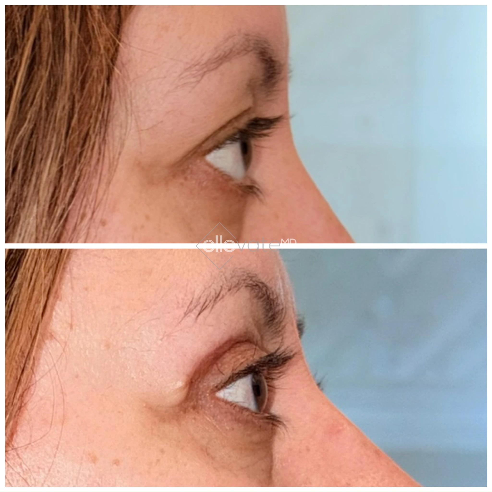 Before and after profile view of upper eyelid lift results