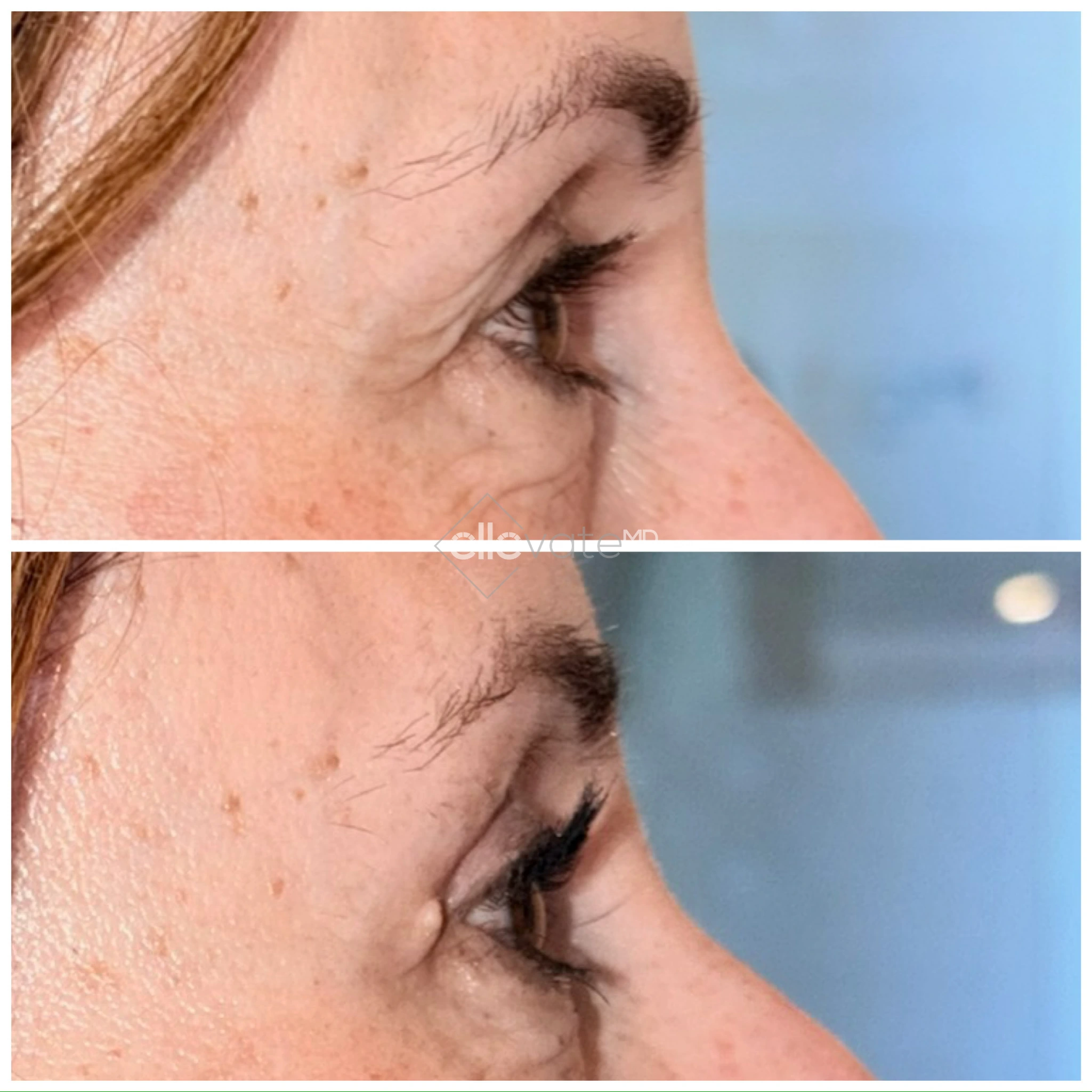 Before and after profile view of upper eyelid with improved lid elevation and contour