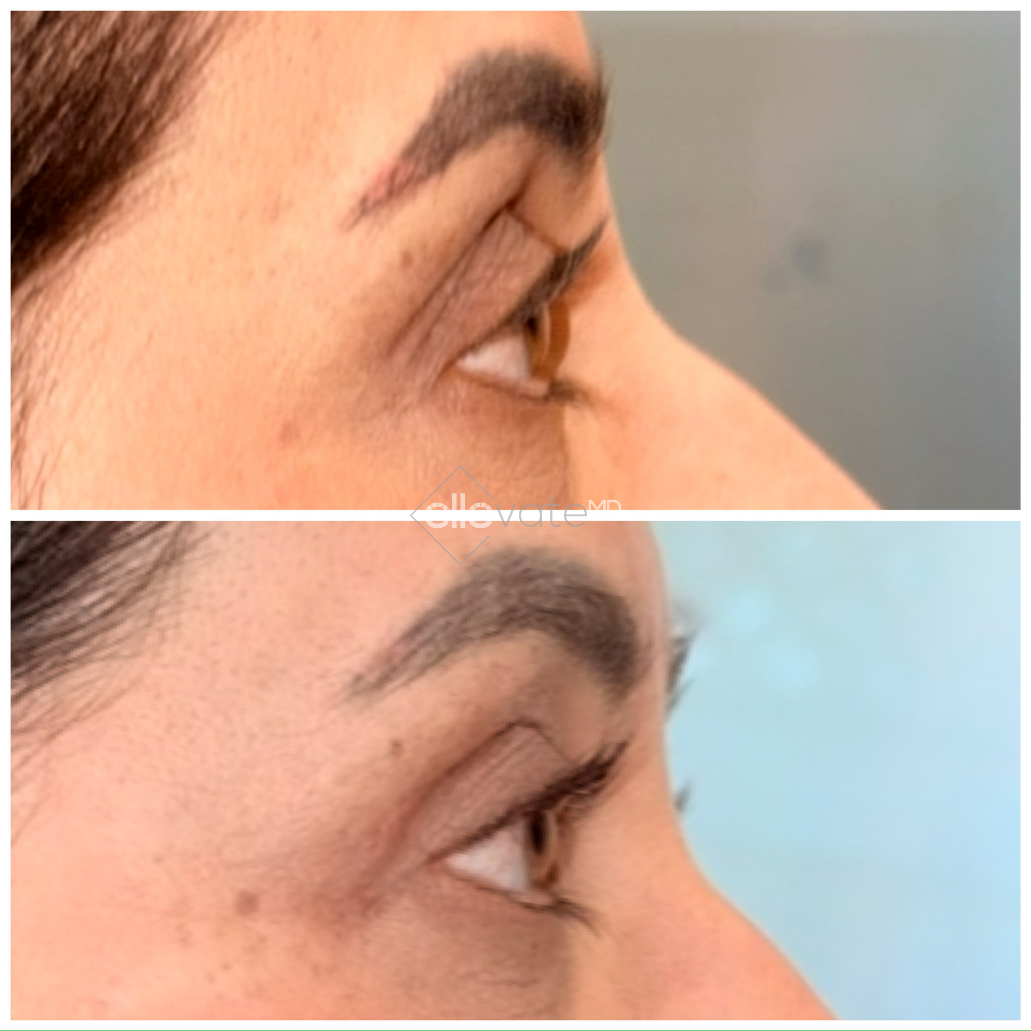 Before and after profile view showing upper lid lift with enhanced eyelid definition