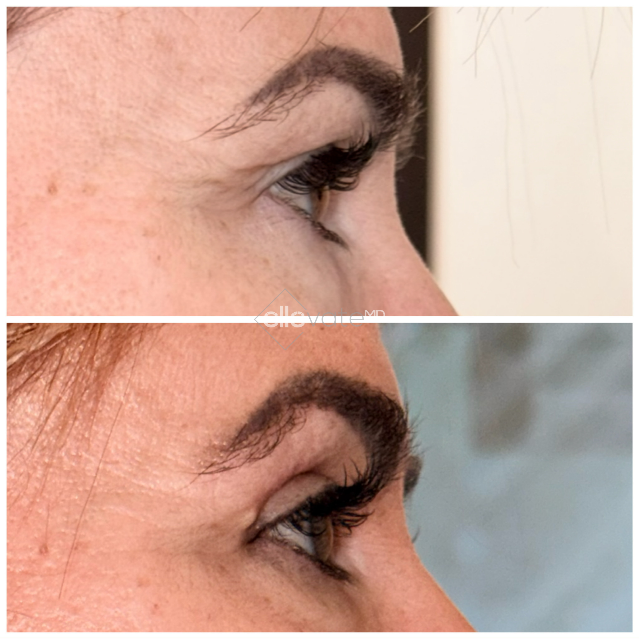 Before and after profile view of upper eyelid demonstrating lifted appearance and rejuvenation
