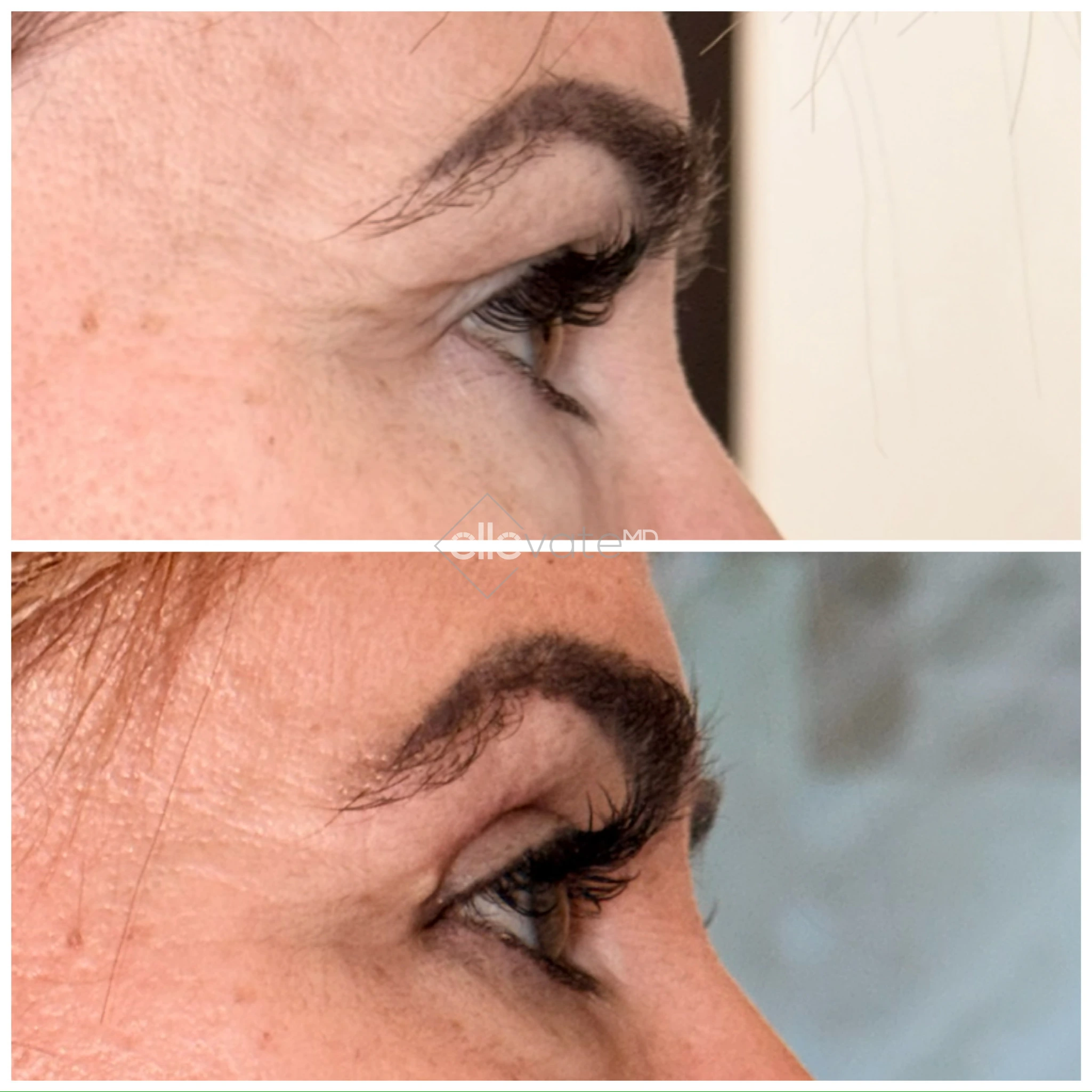 Before and after profile view of upper eyelid demonstrating lifted appearance and rejuvenation